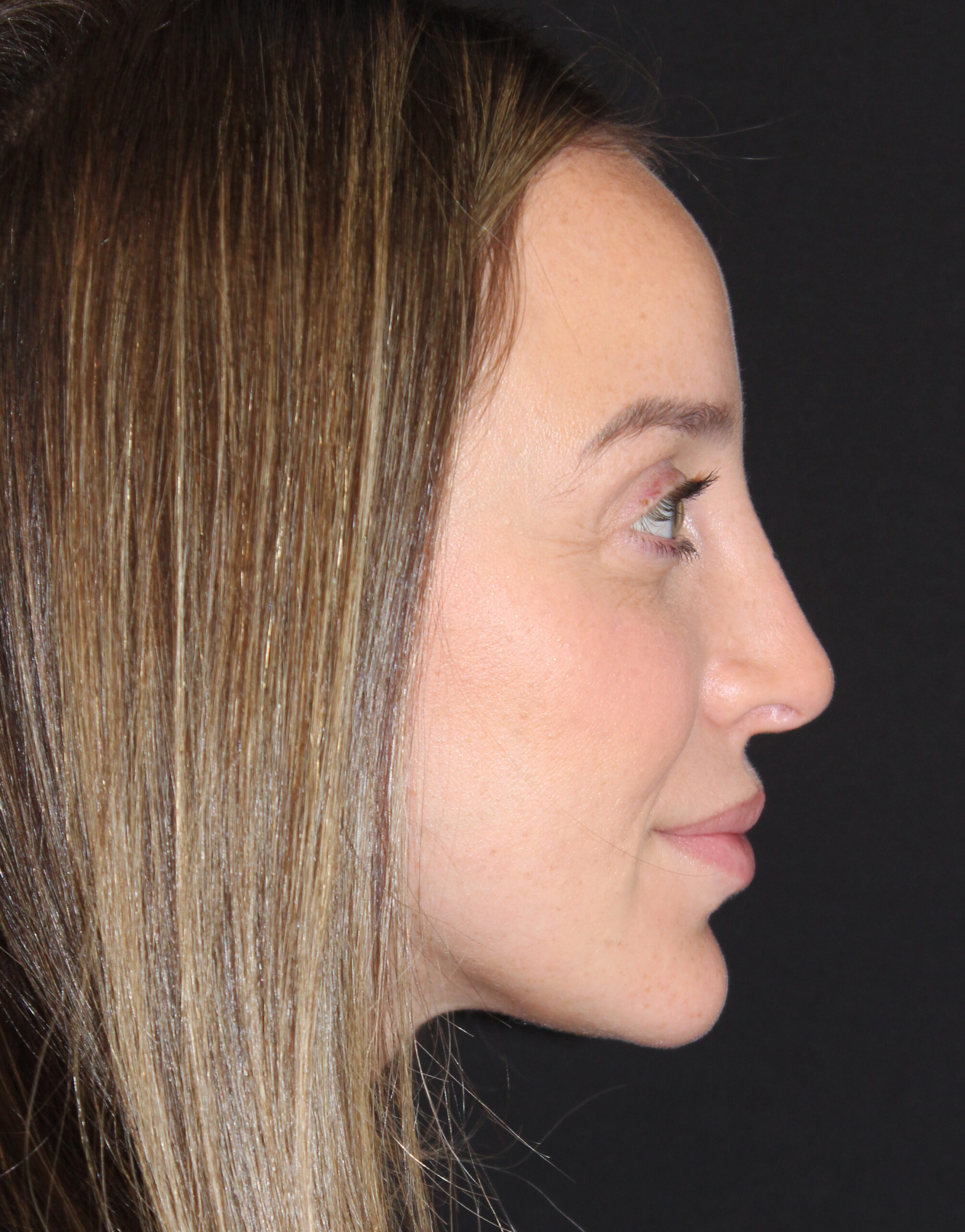 Patient #110 After Image