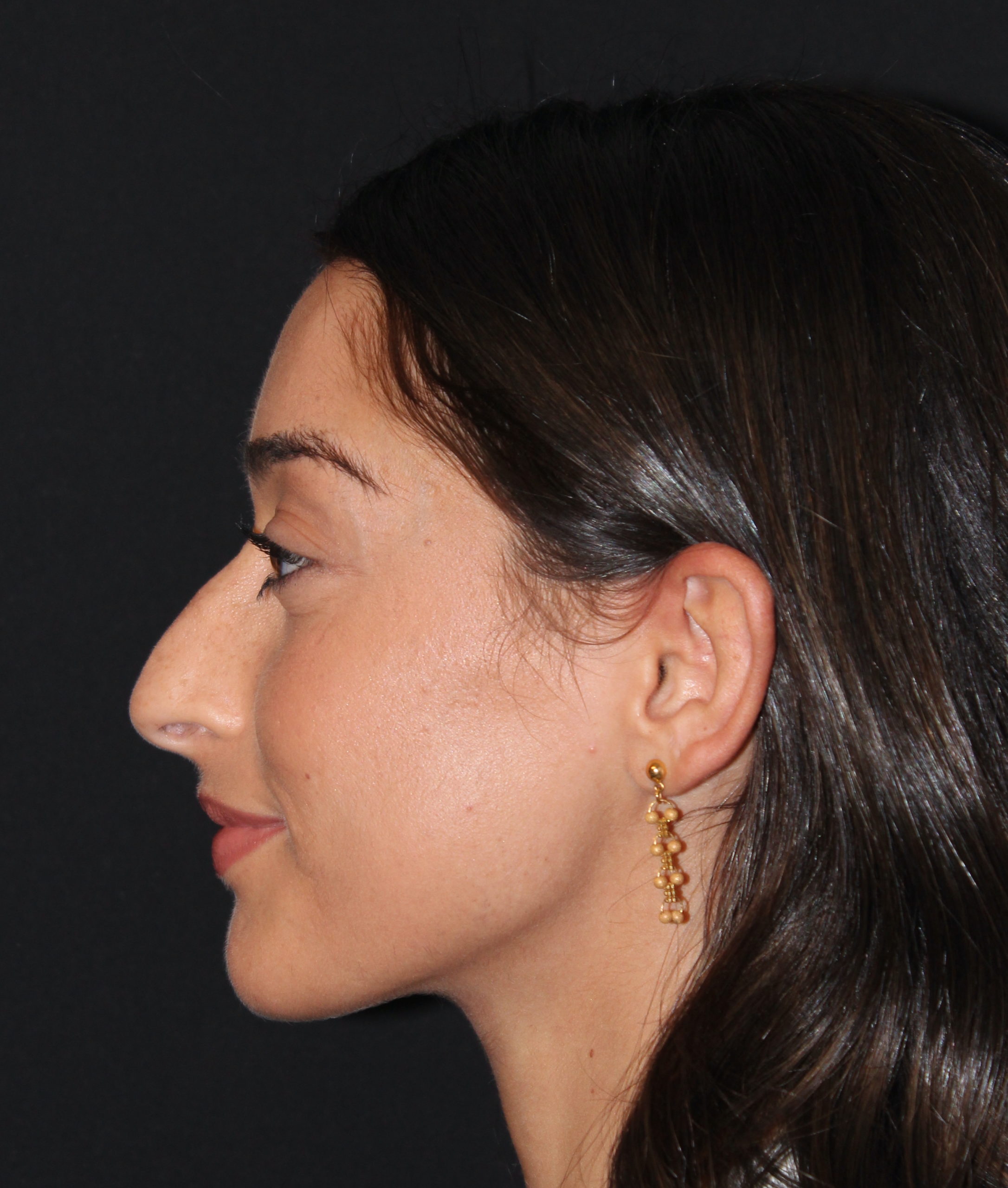 Patient 84 Before Image