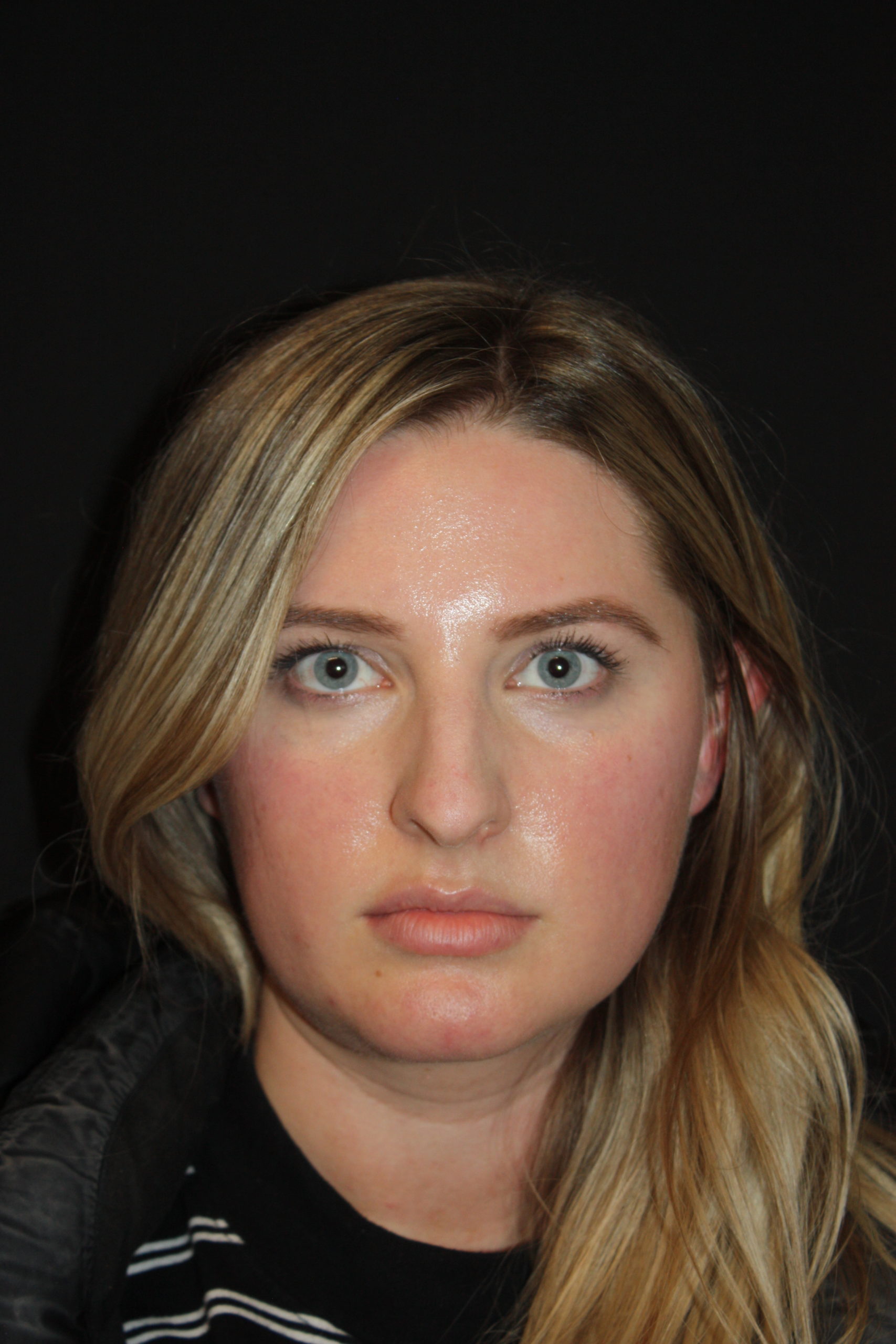 Patient 62 Before Image