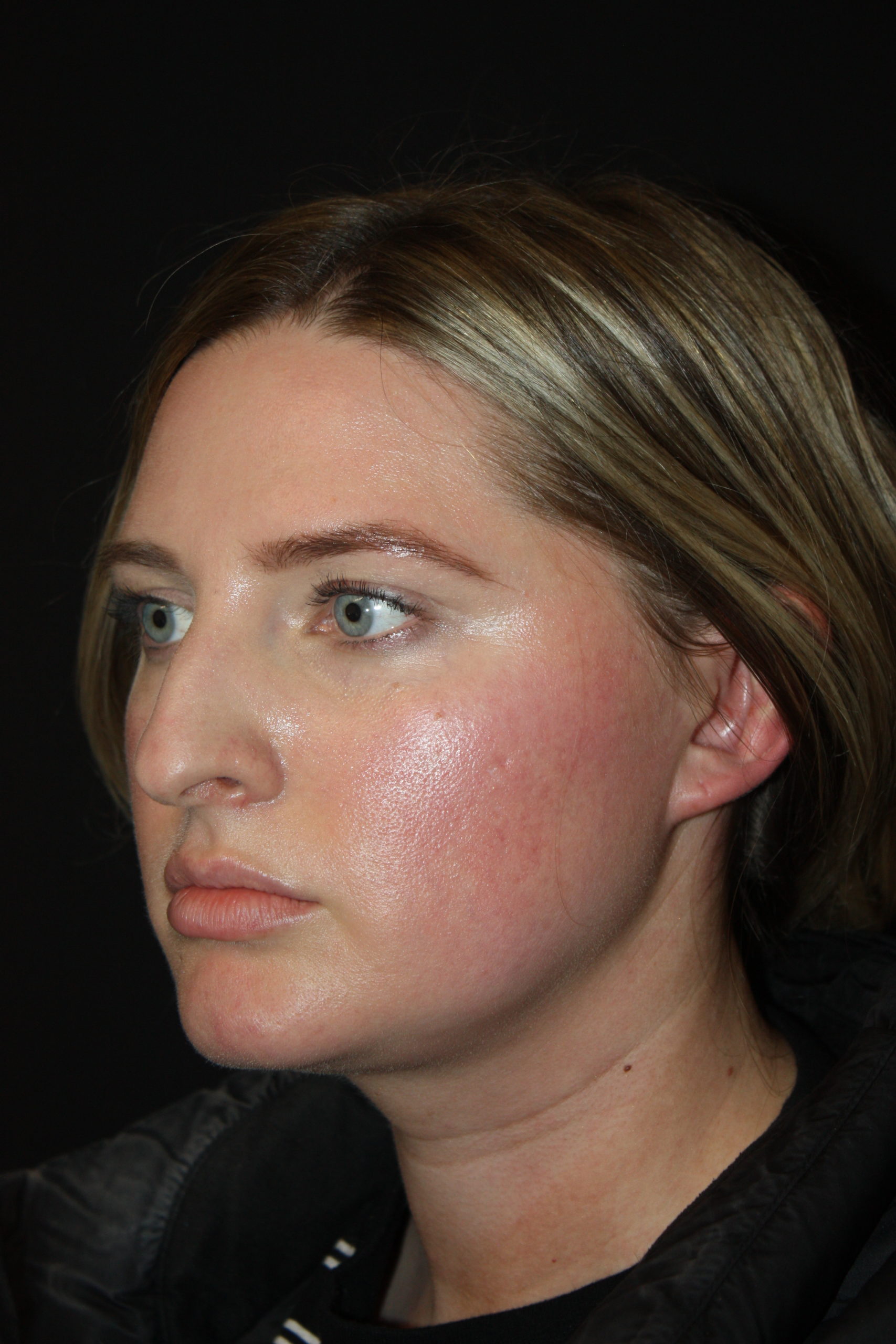 Patient 62 Before Image