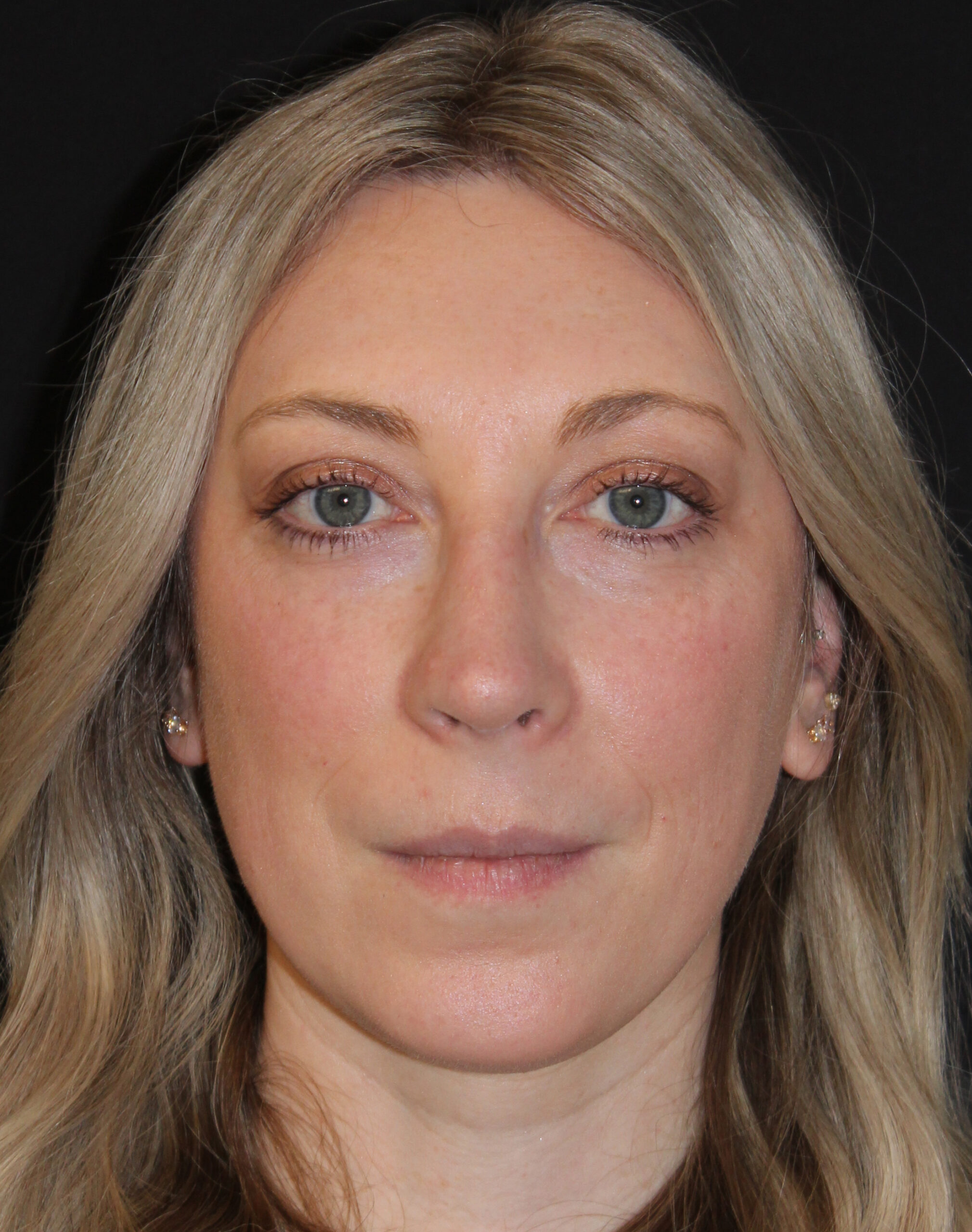 Patient #146 After Image