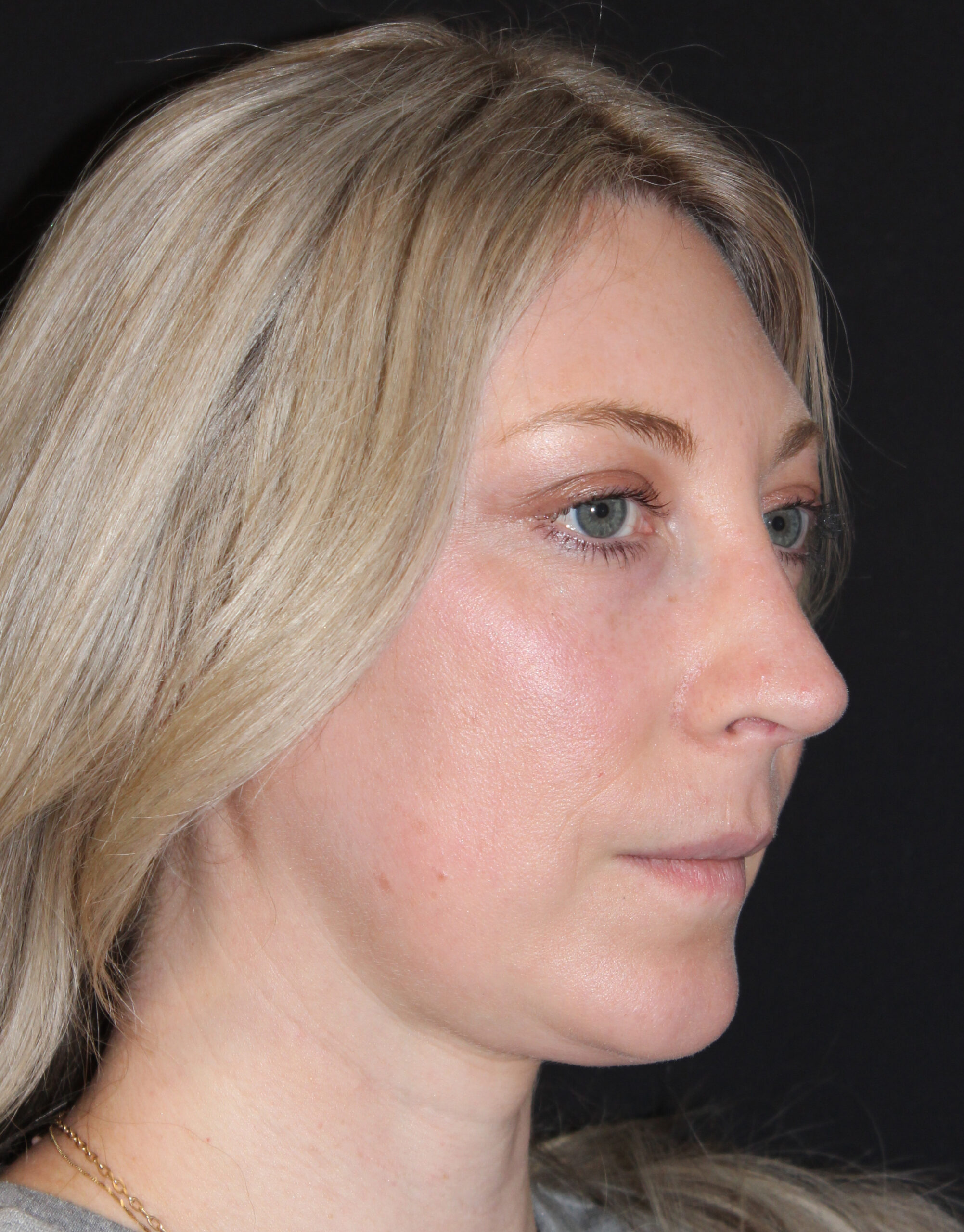 Patient #146 After Image