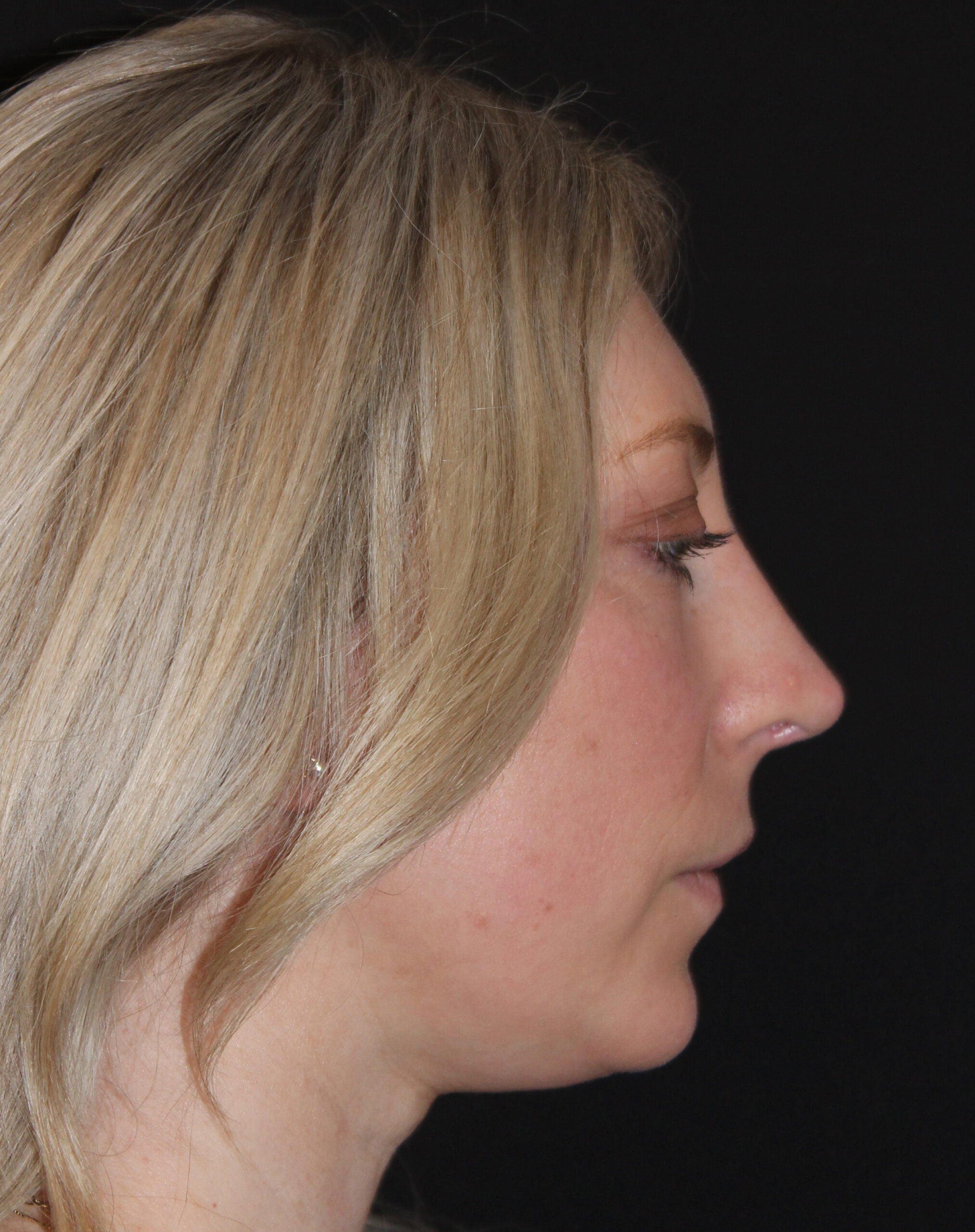 Patient #146 After Image