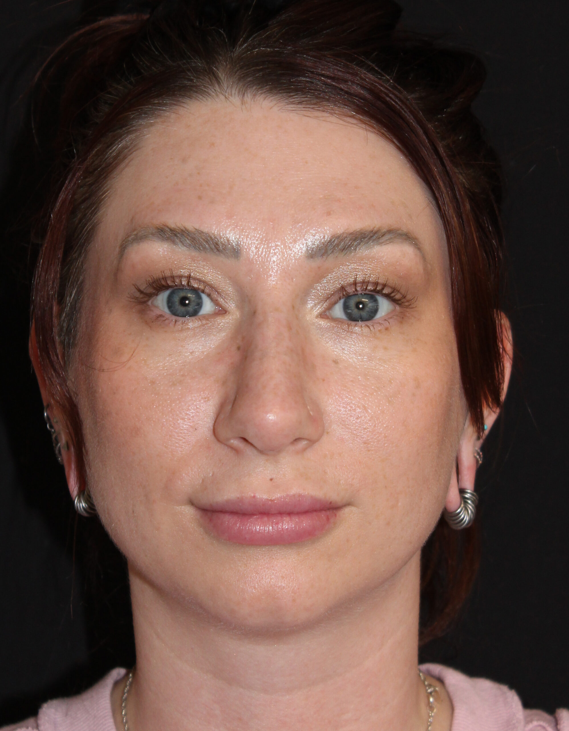 Patient #169 After Image