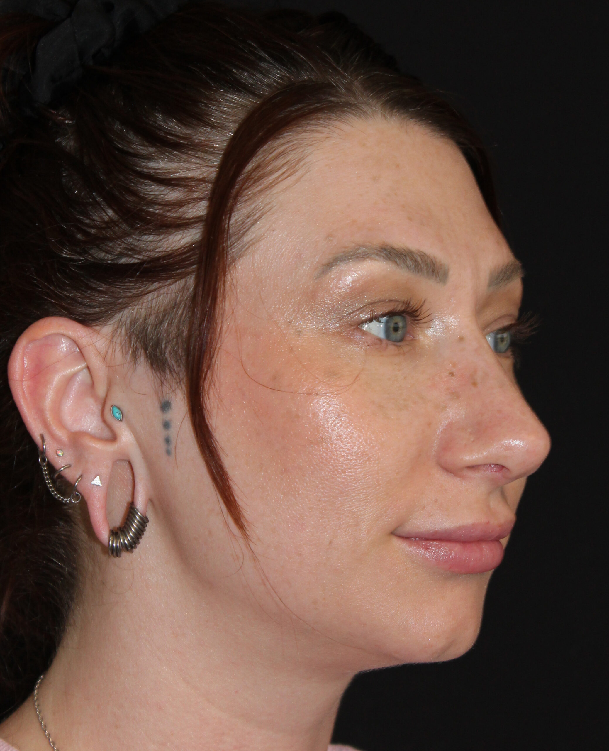 Patient #169 After Image