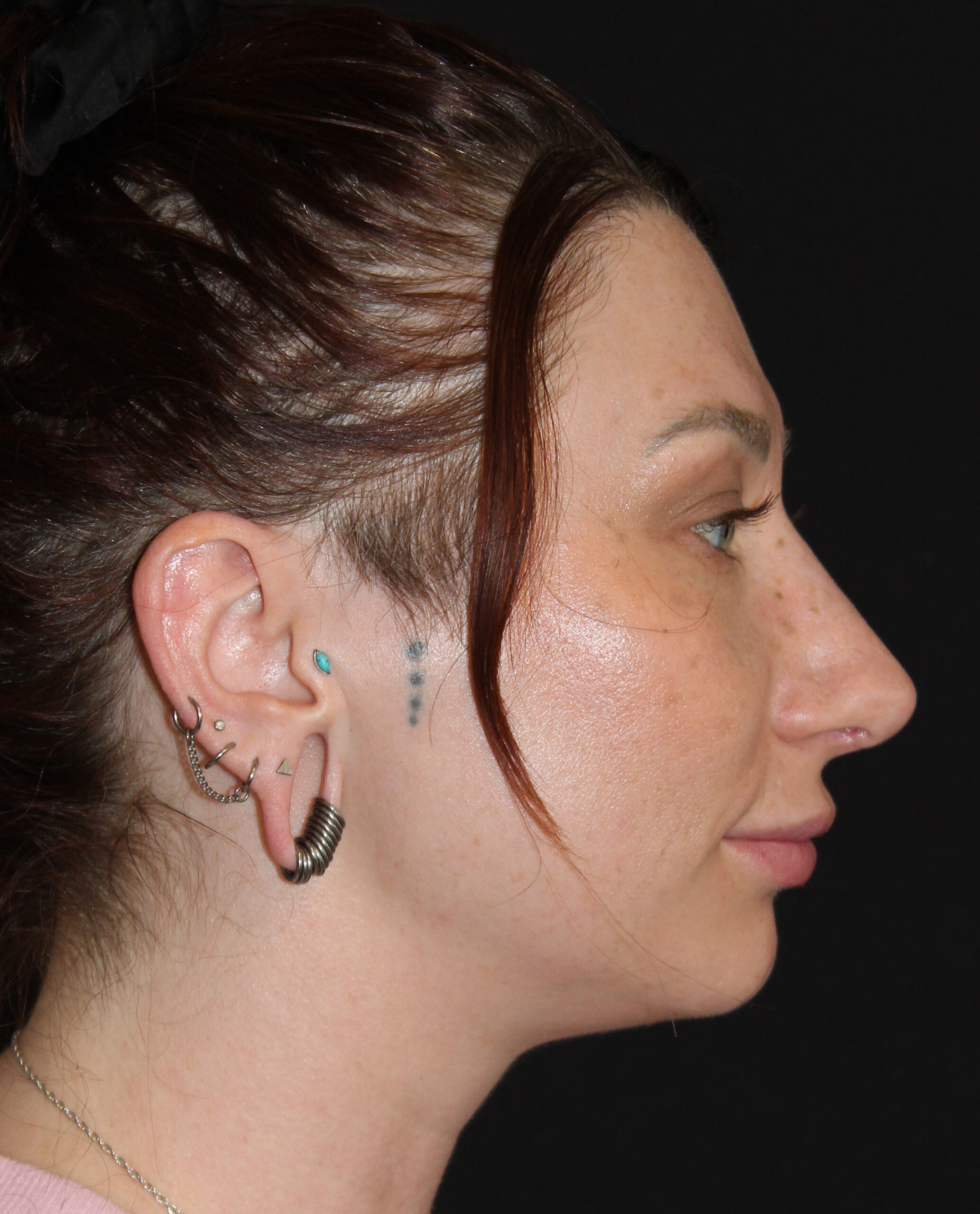 Patient #169 After Image