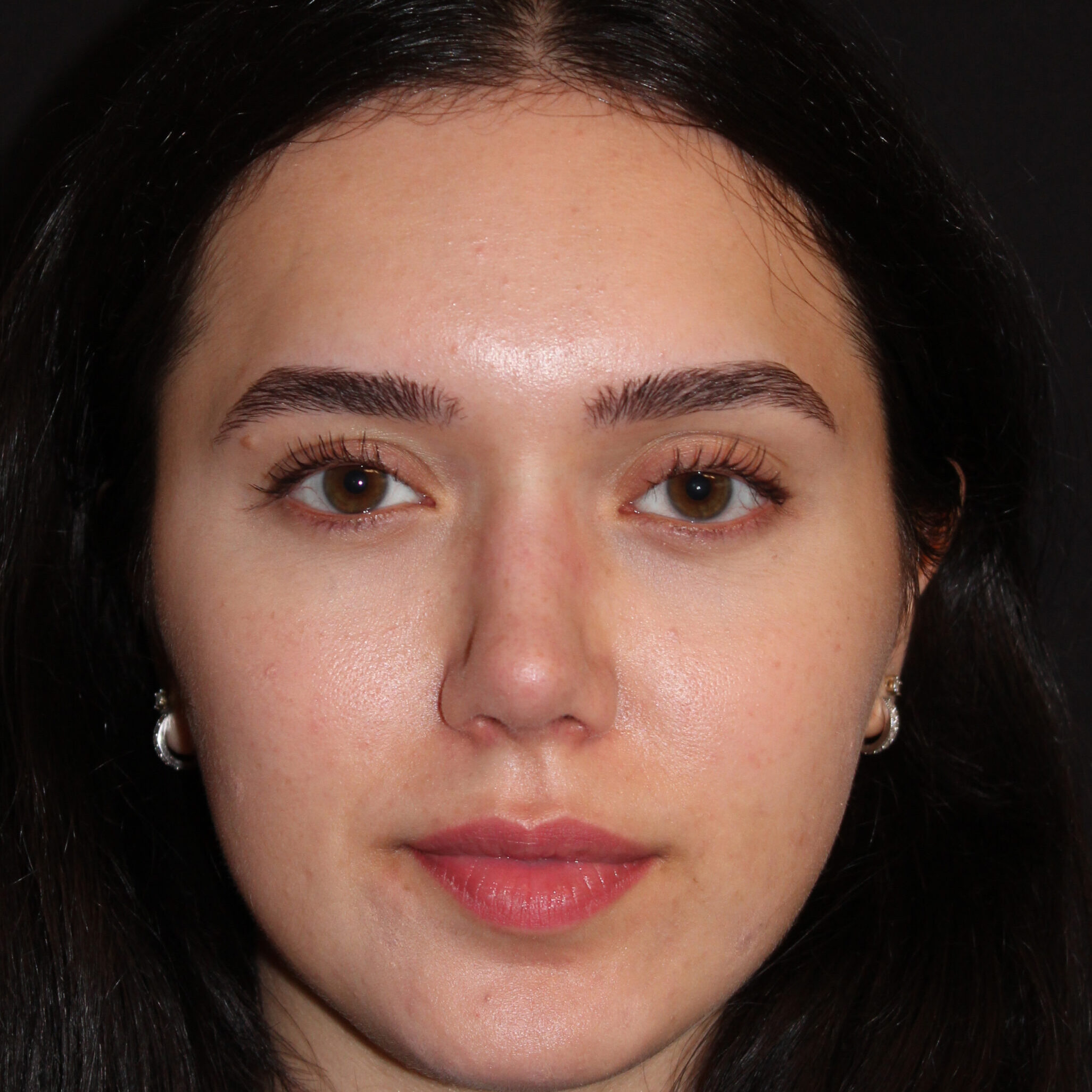 Patient #171 After Image