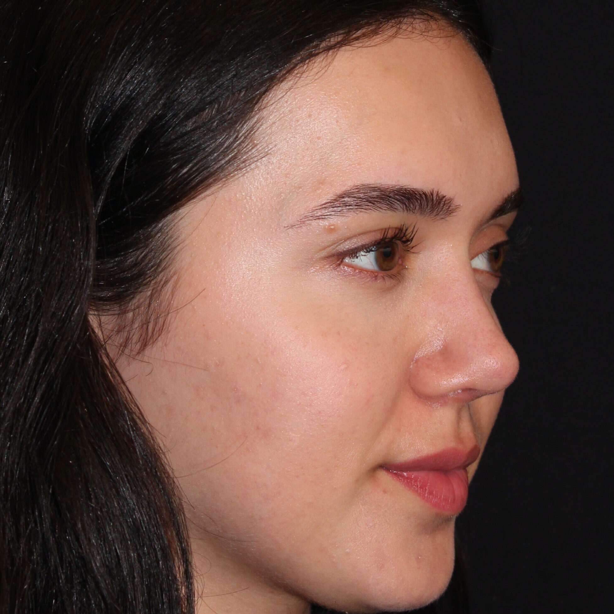 Patient #171 After Image