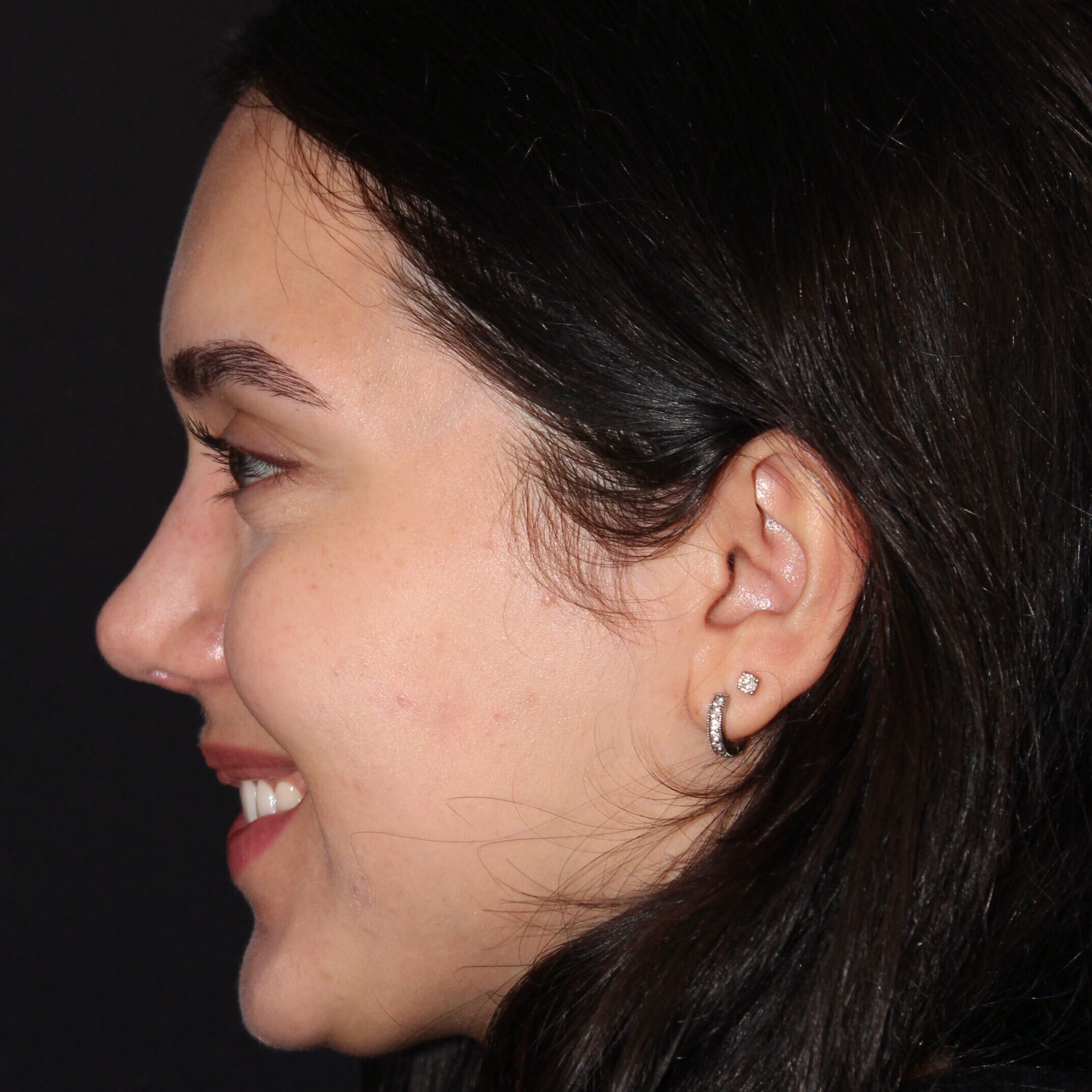 Patient #171 After Image