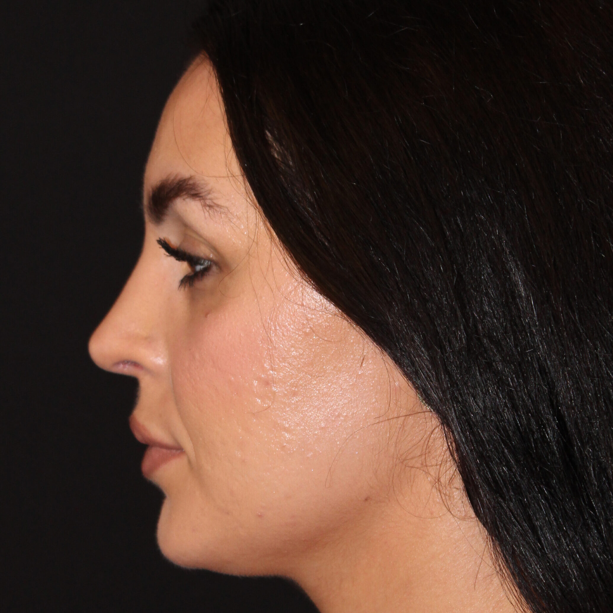 Patient #172 After Image