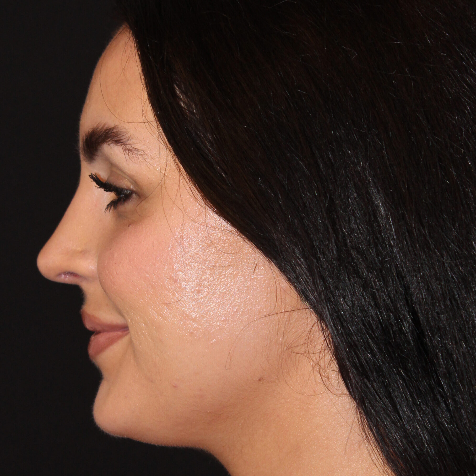 Patient #172 After Image