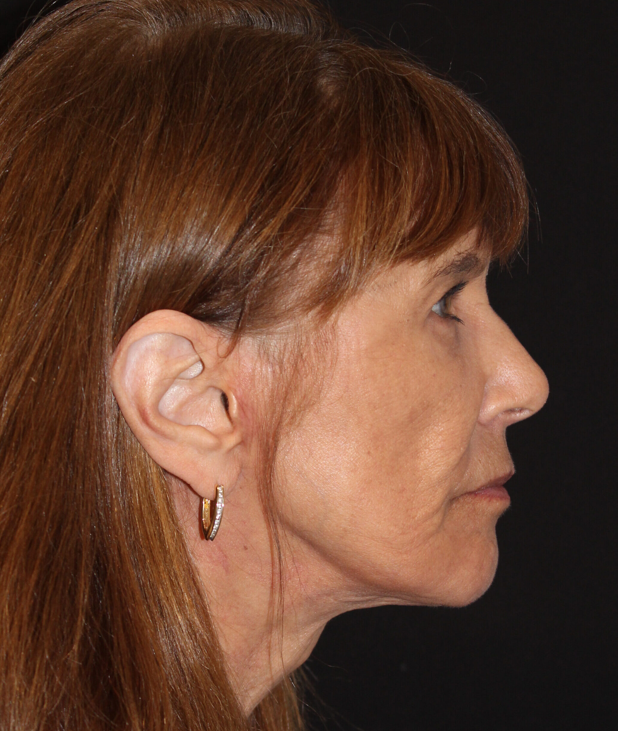 Patient #176 After Image