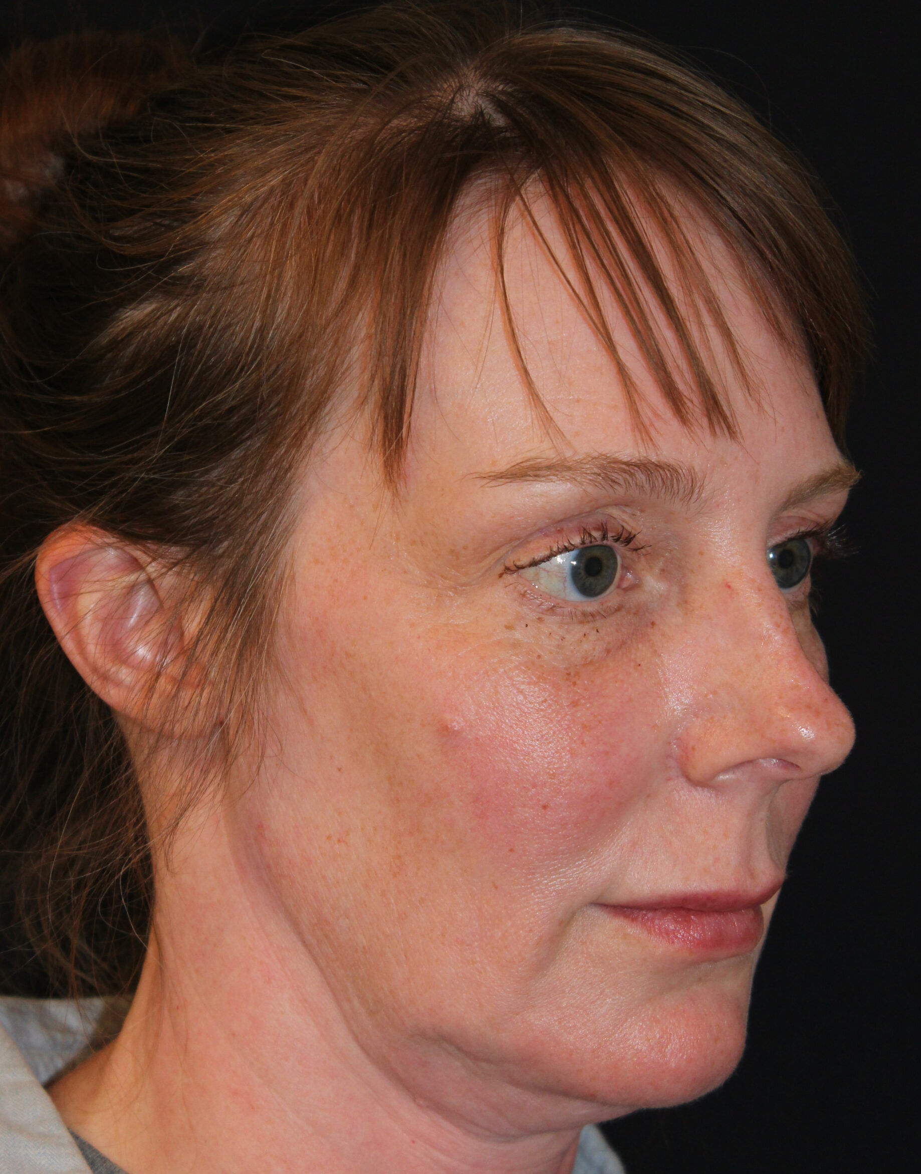 Patient #182 Before Image