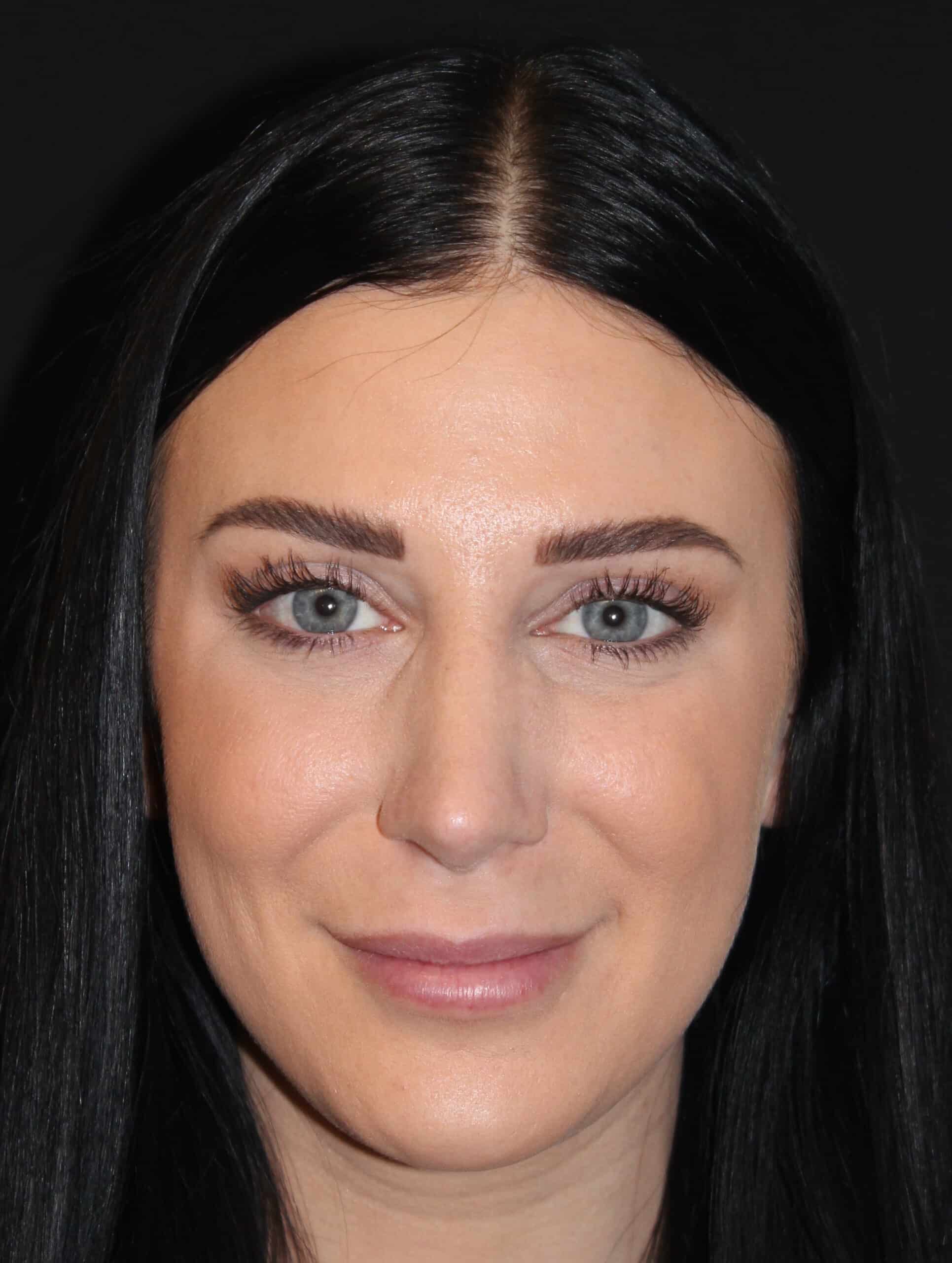 Patient 93 After Image