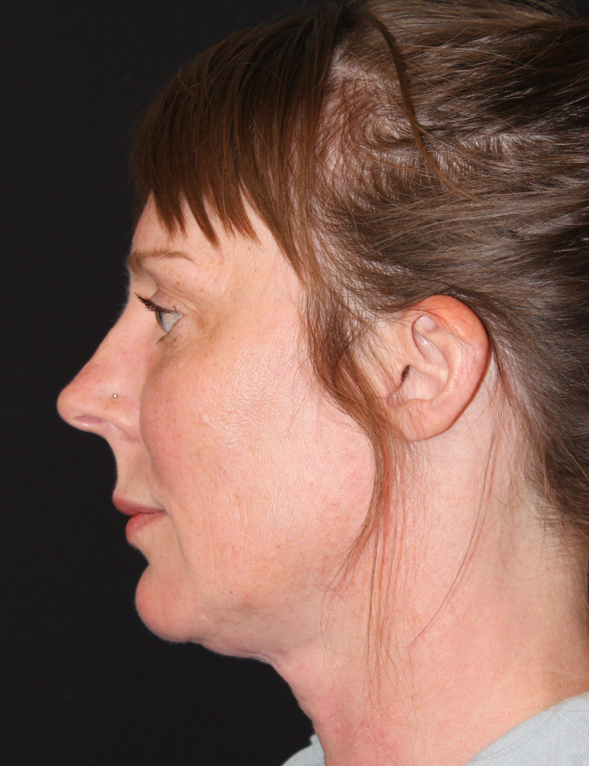 Patient #182 Before Image