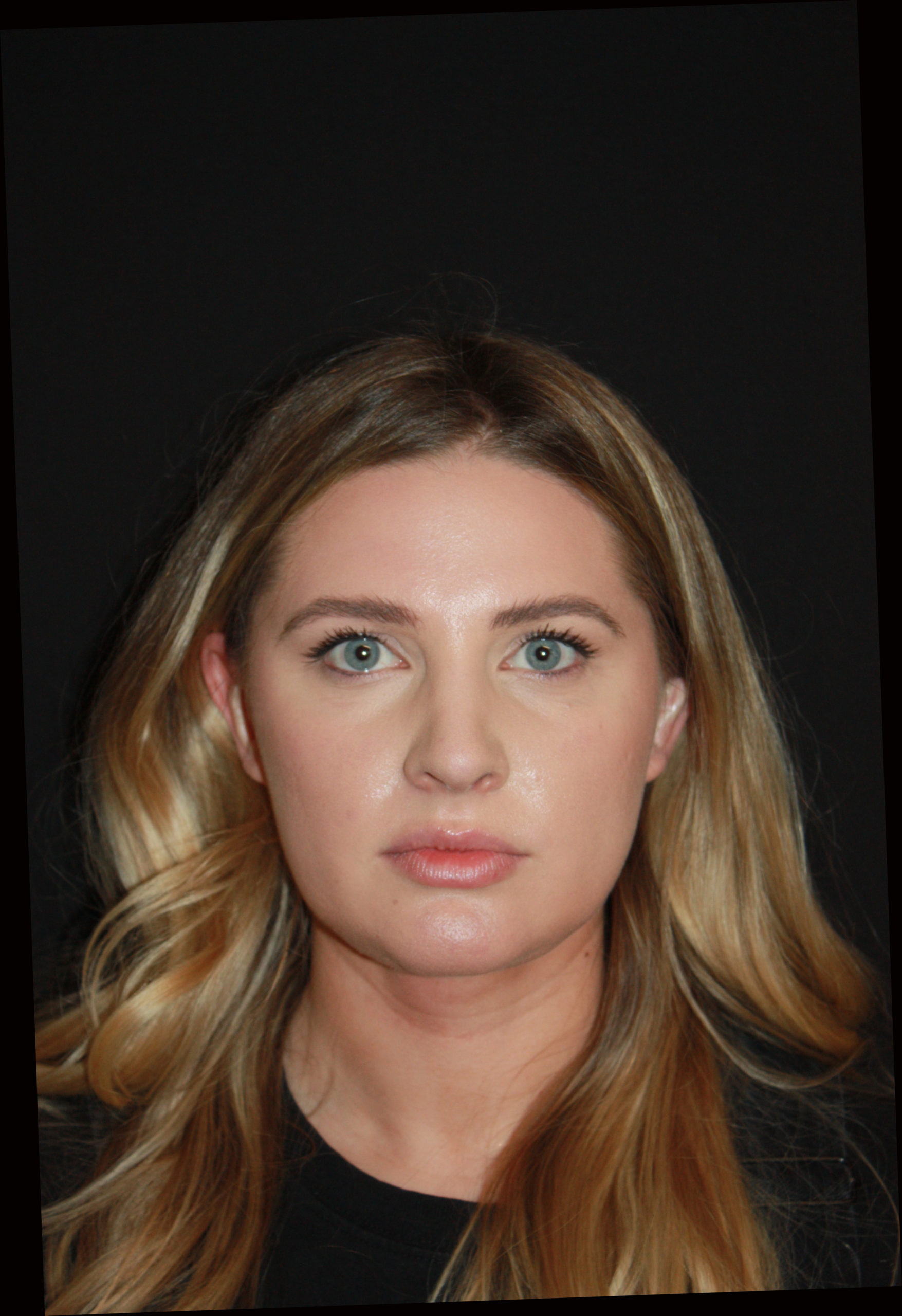 Patient 62 After Image