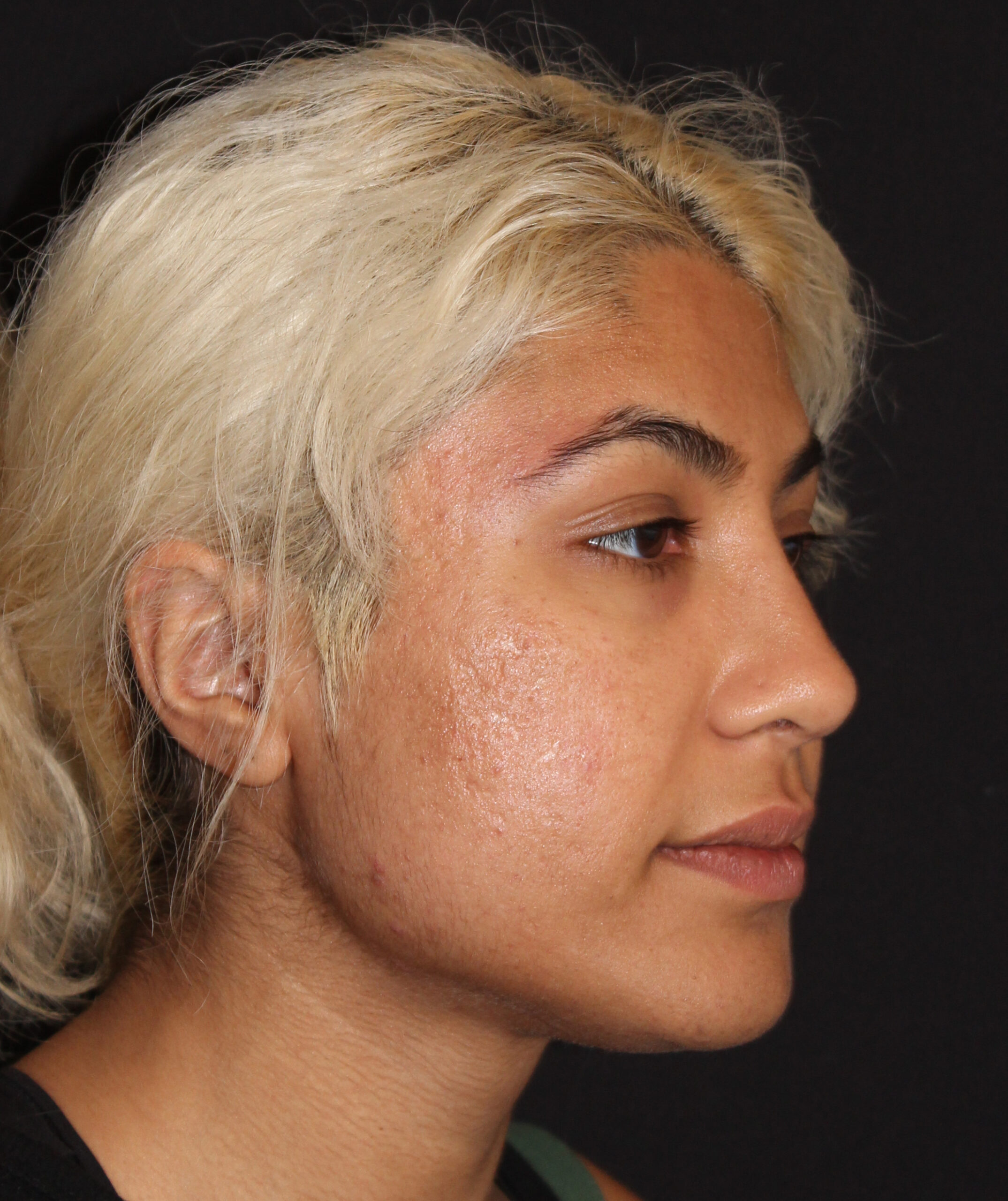 Patient #174 After Image