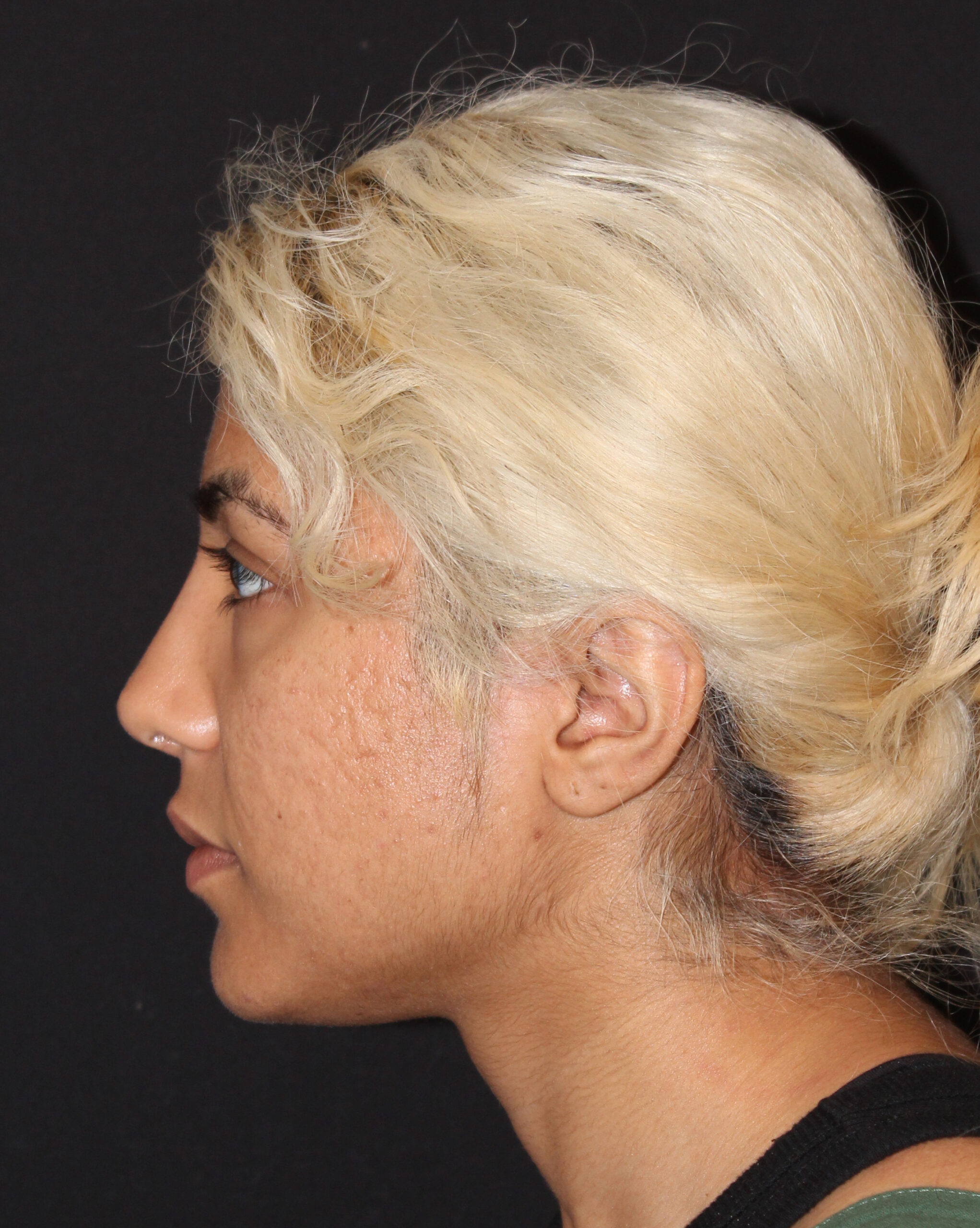 Patient #174 After Image