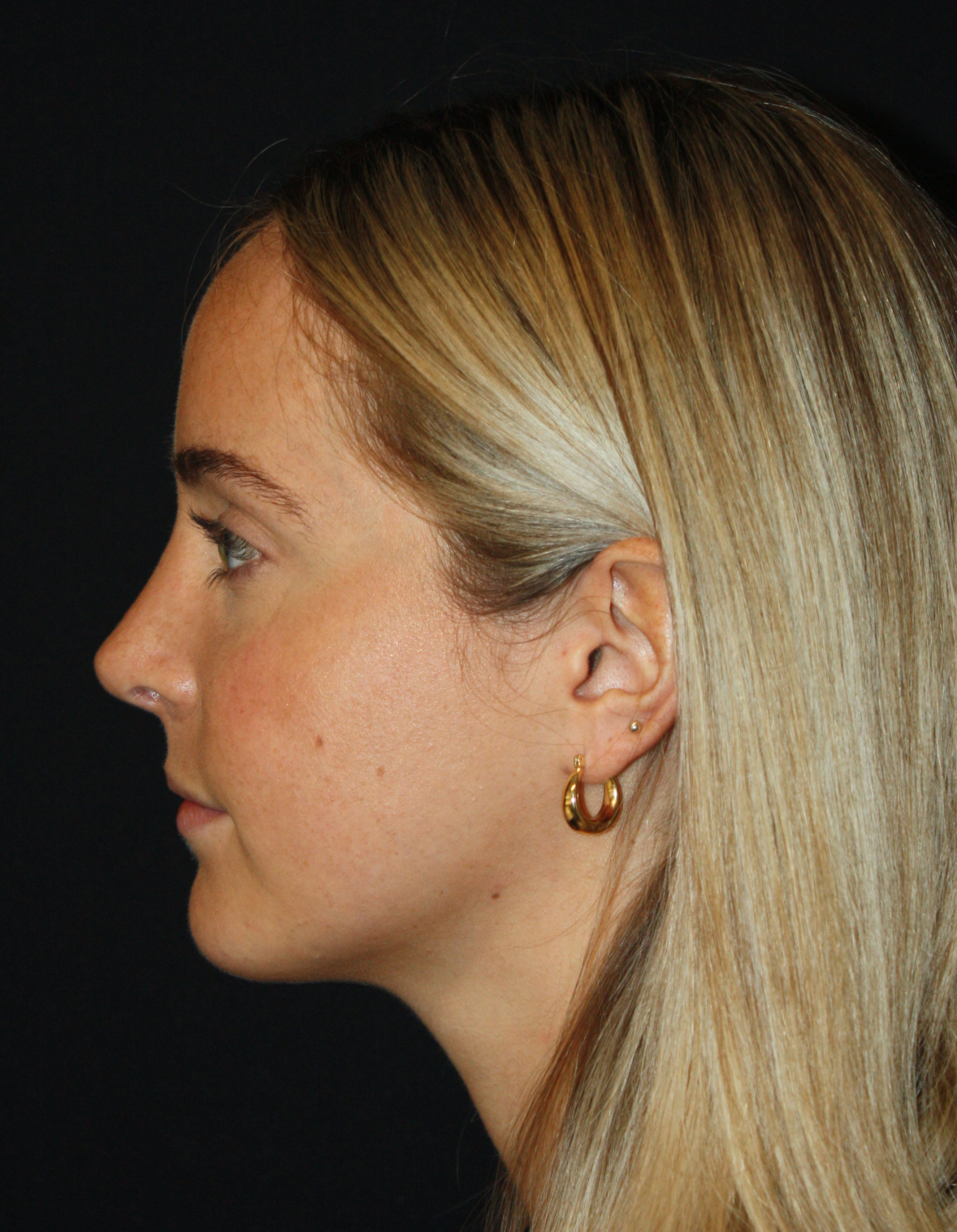 Patient 57 After Image