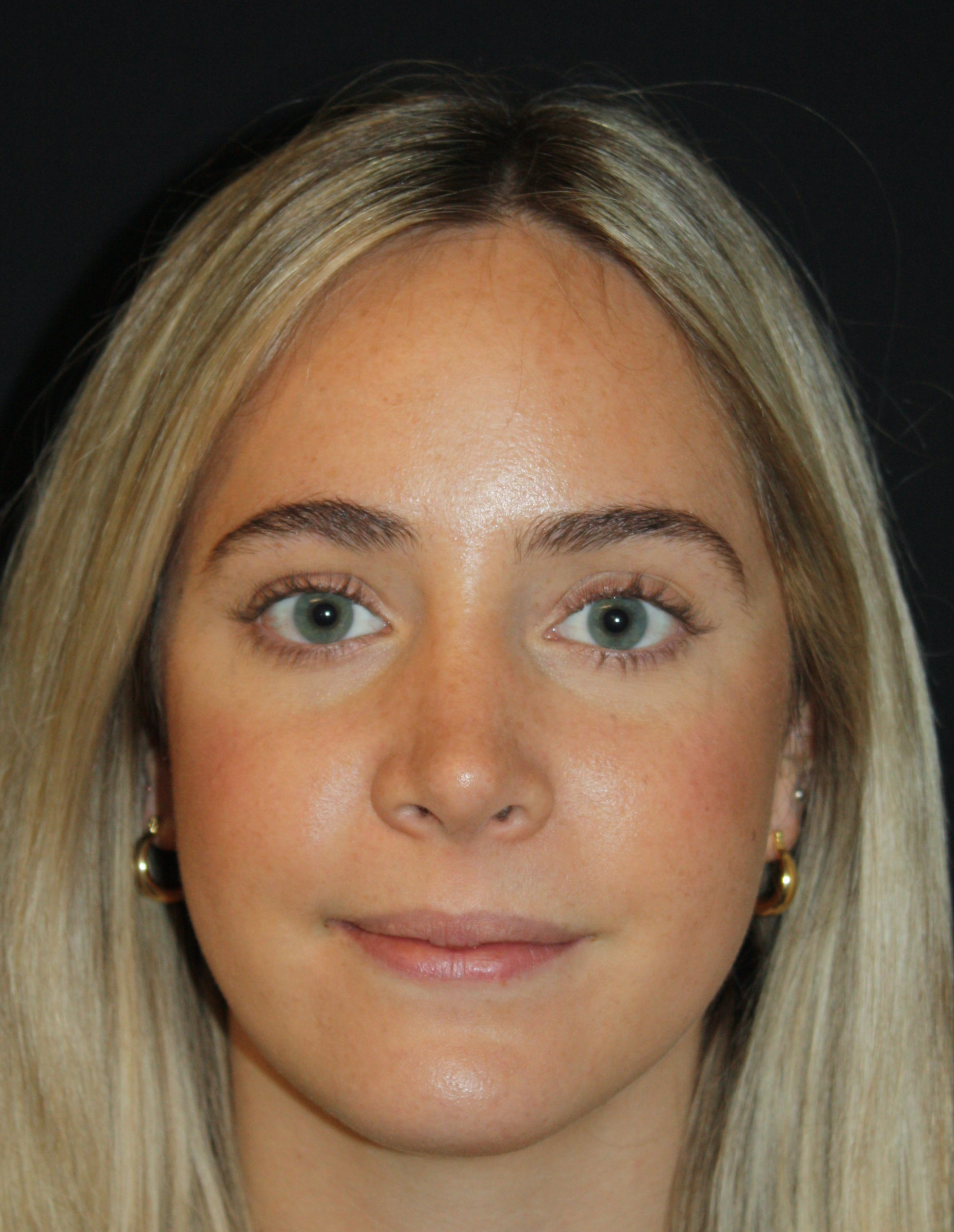 Patient 57 After Image