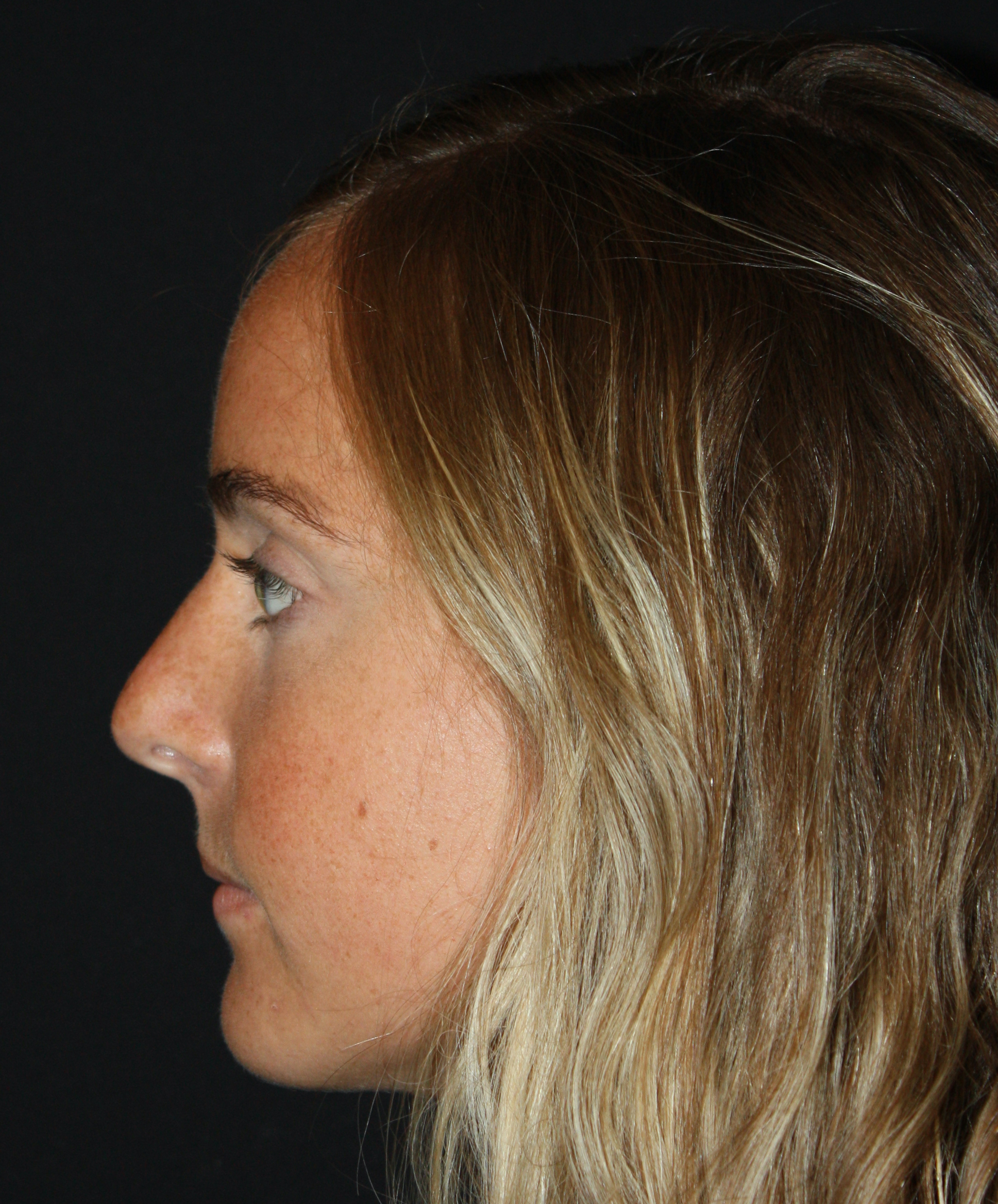 Patient 57 Before Image