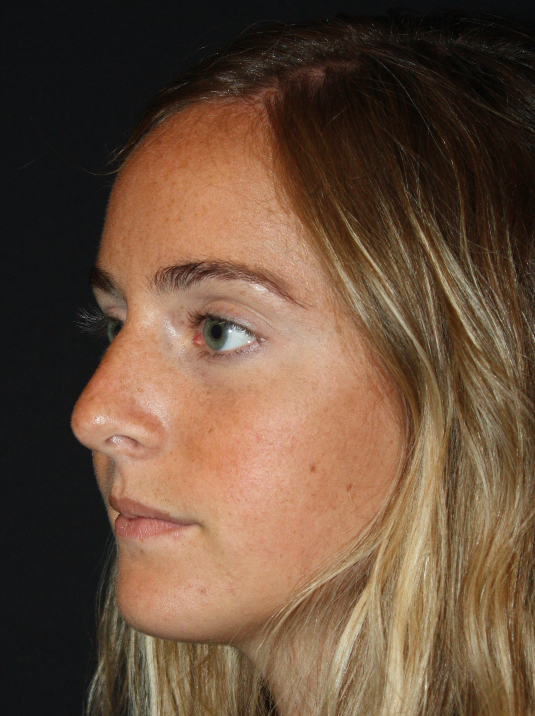 Patient 57 Before Image