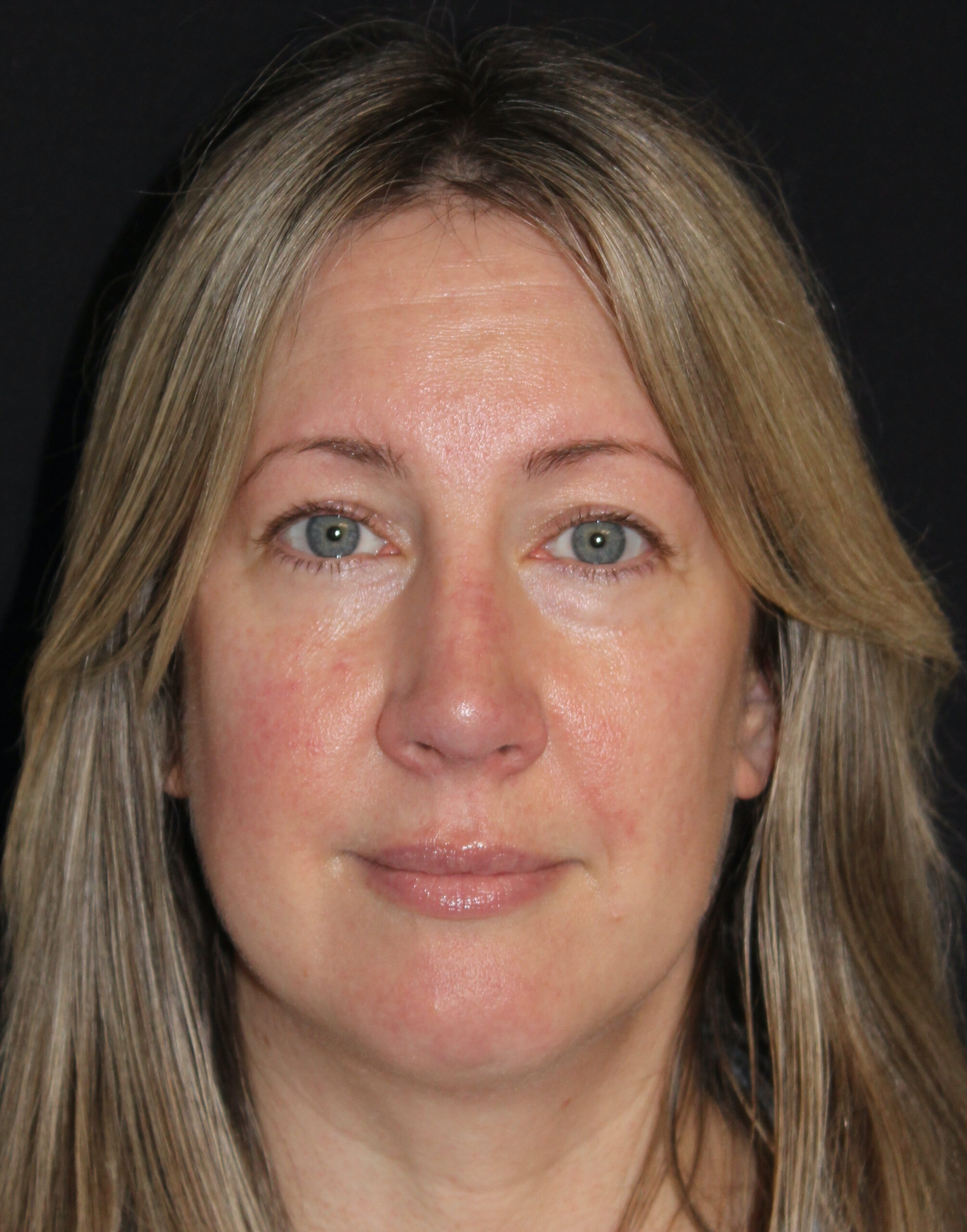 Patient 105 After Image