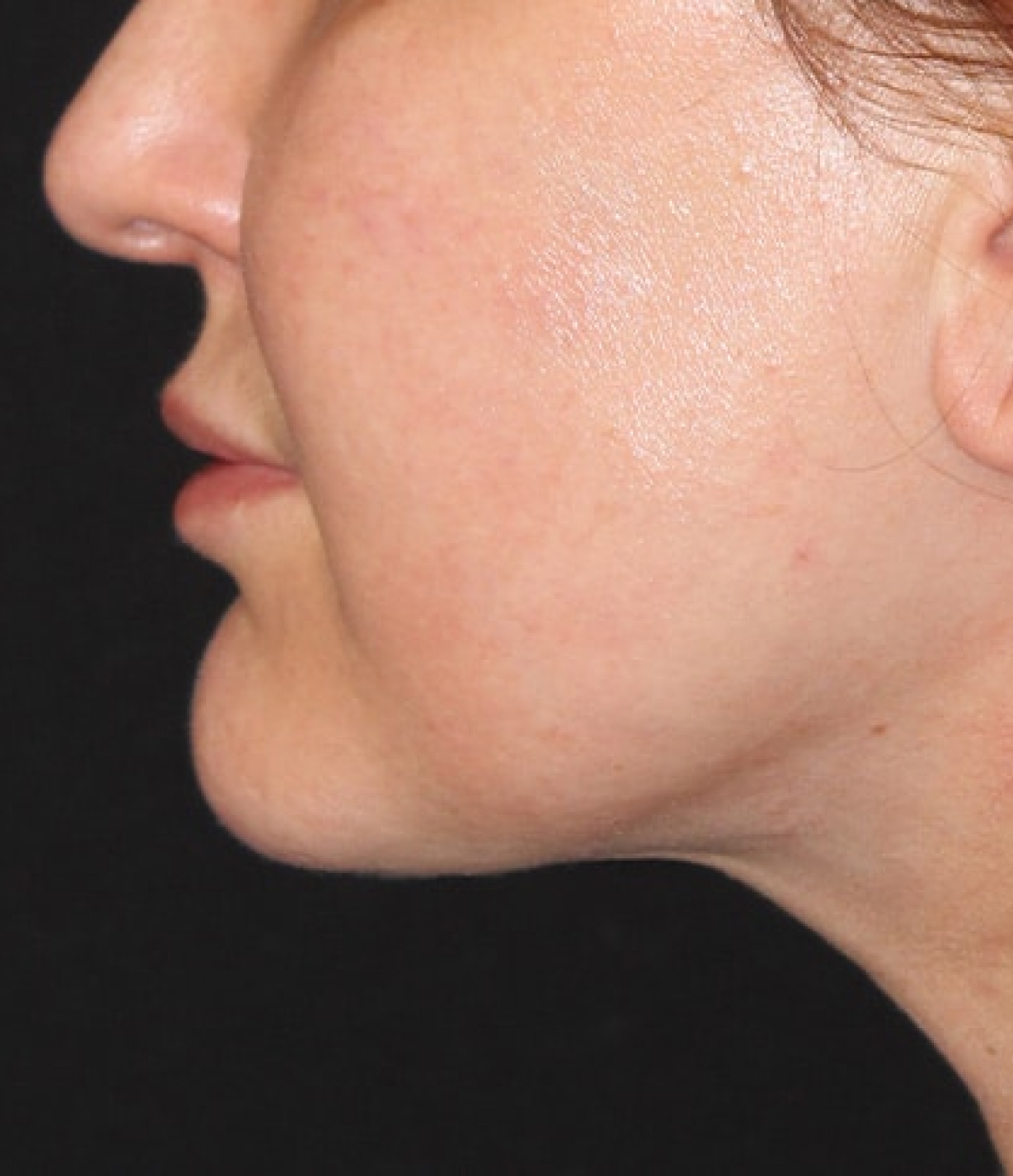 Patient 95 After Image