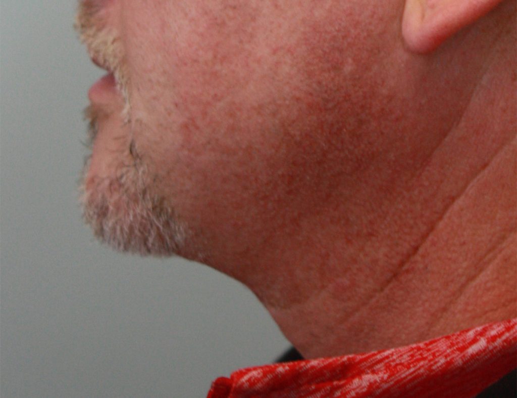 Patient 19 After Image