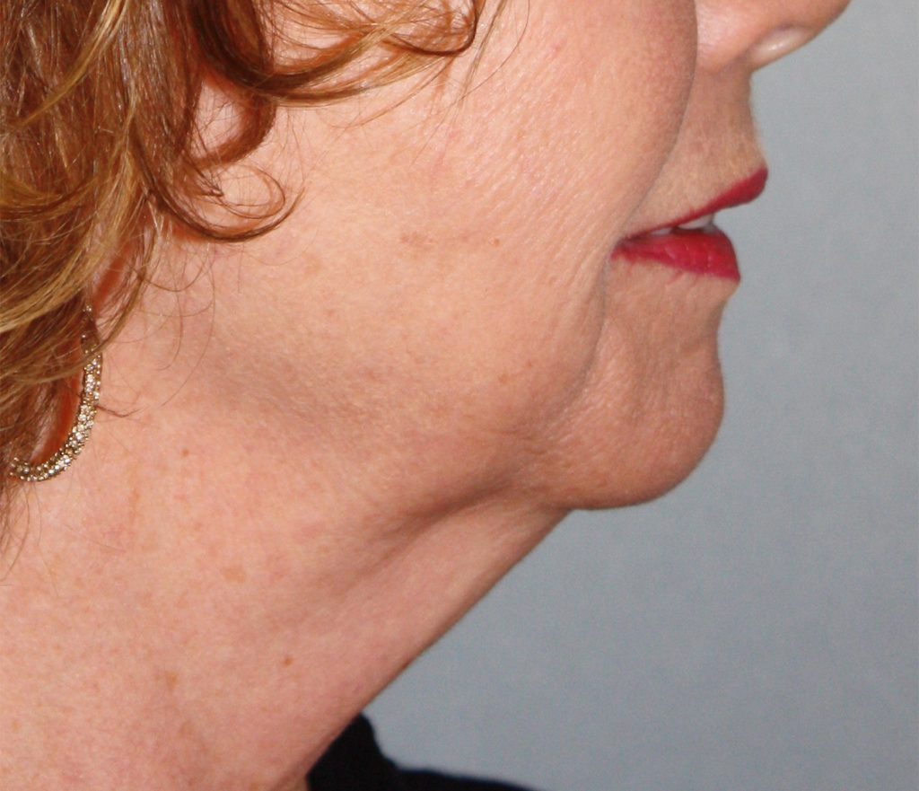 Patient 21 Before Image