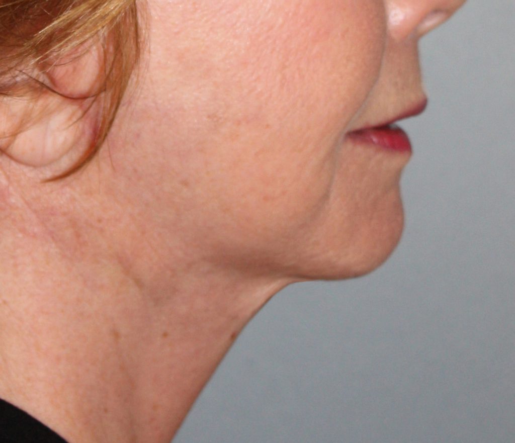 Patient 21 After Image