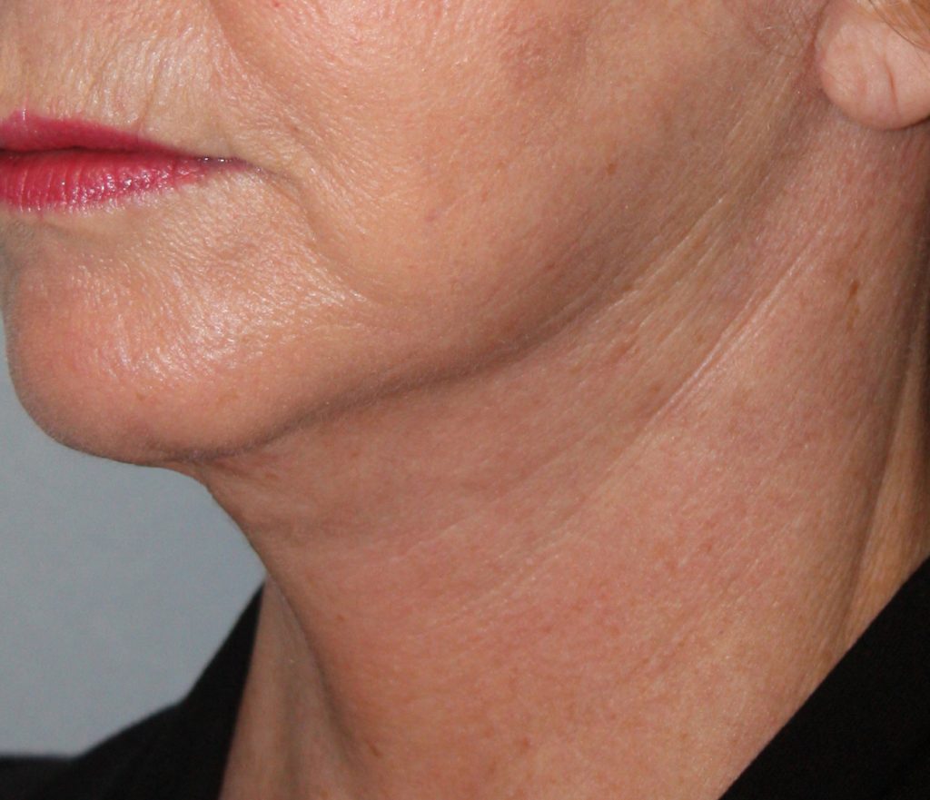 Patient 21 After Image