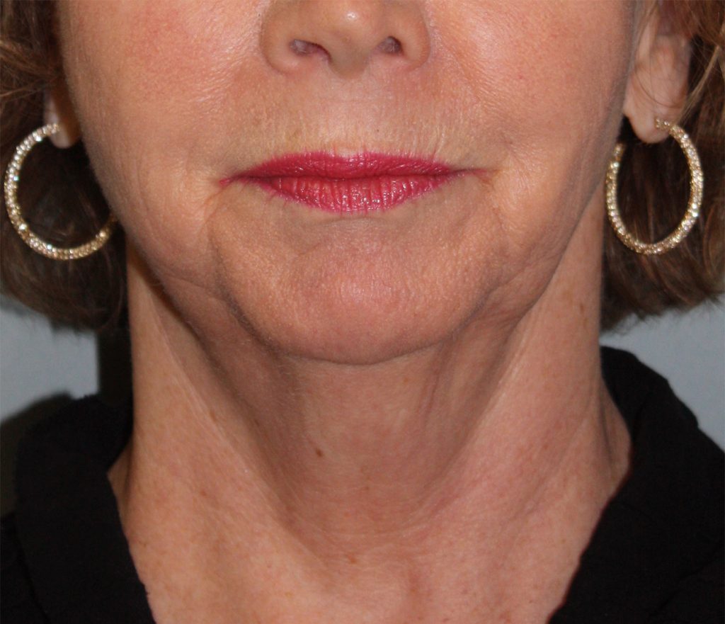 Patient 21 Before Image