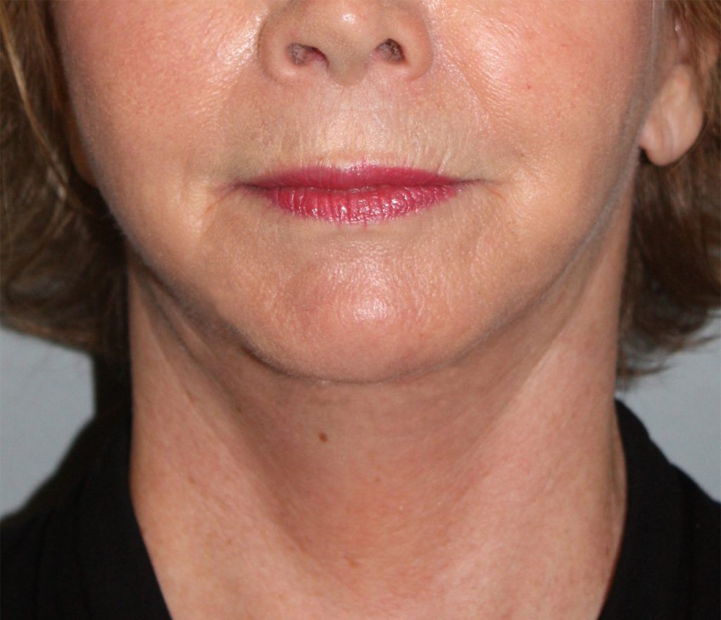 Patient 21 After Image