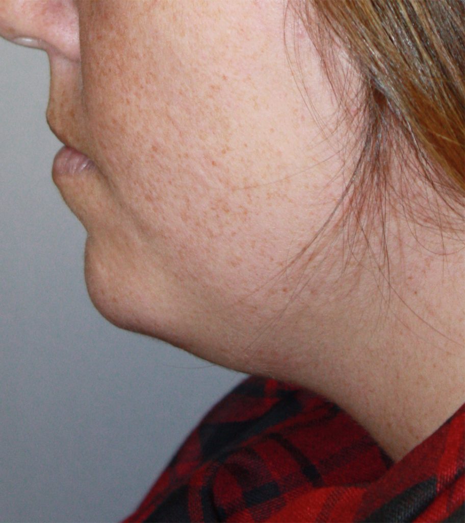 Patient 22 Before Image