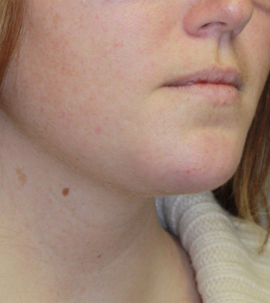 Patient 22 After Image