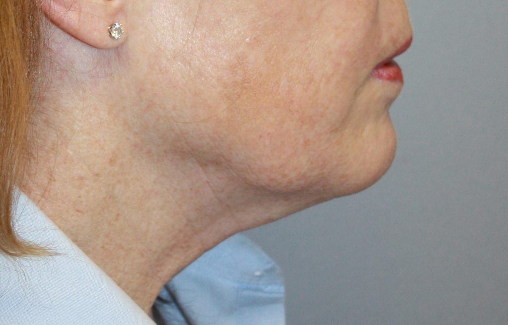 Patient 23 Before Image