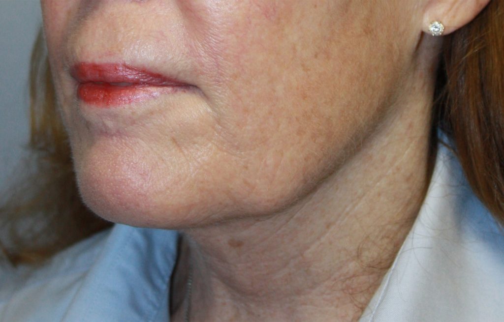 Patient 23 Before Image