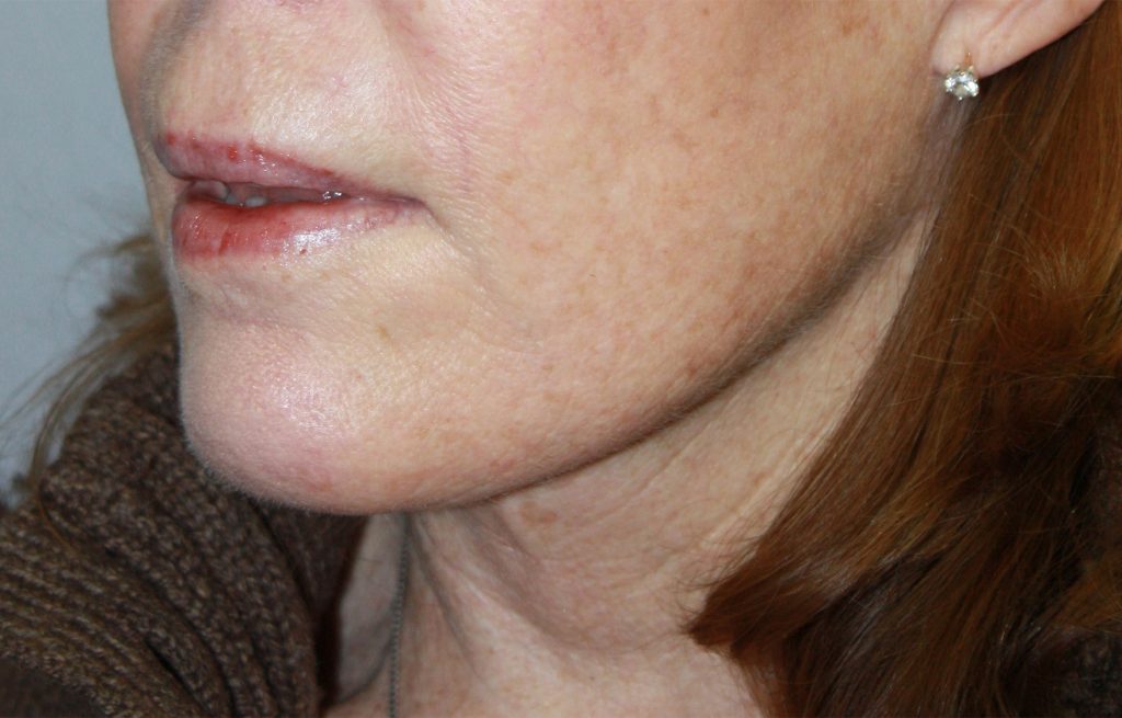 Patient 23 After Image