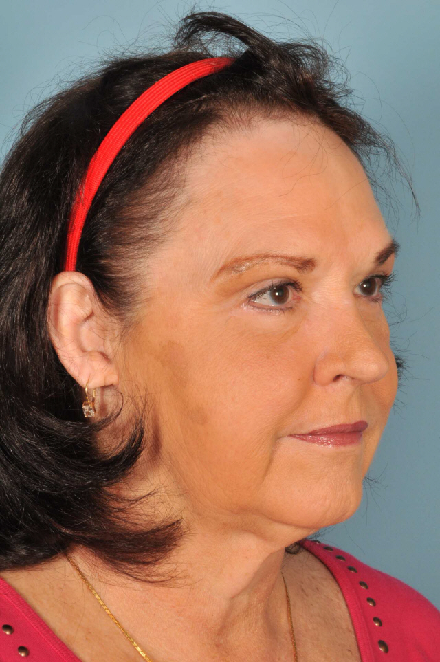 Patient 33 After Image