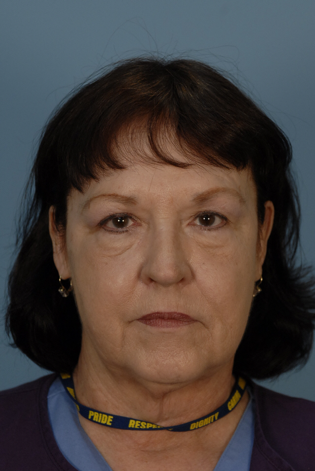 Patient 33 Before Image