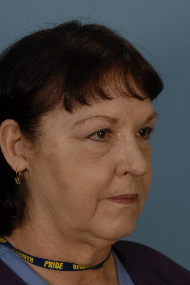 Patient 33 Before Image