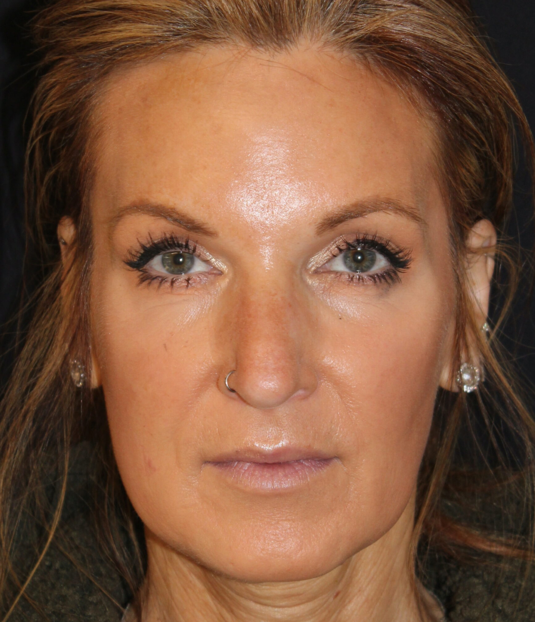 Patient #168 Before Image