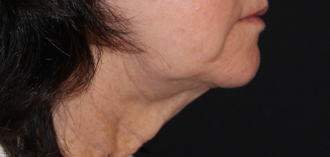 Patient #177 Before Image