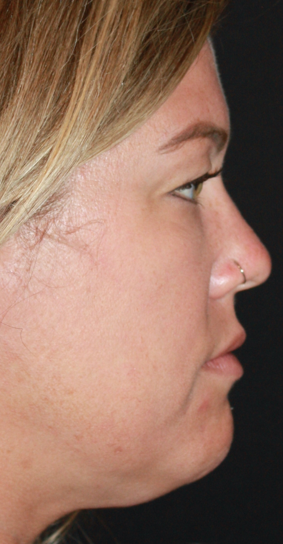 Patient 66 Before Image