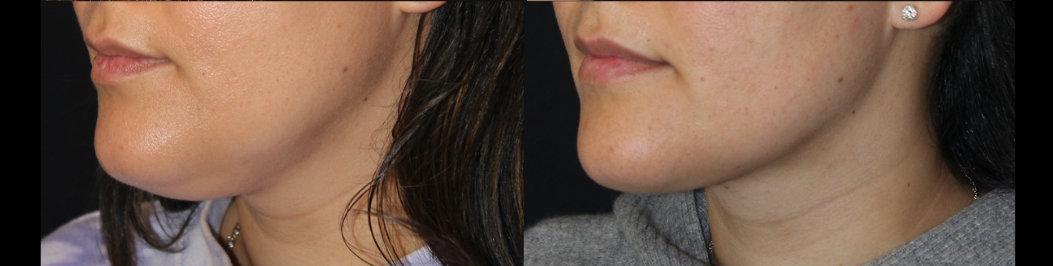 Patient #141 Marge Image