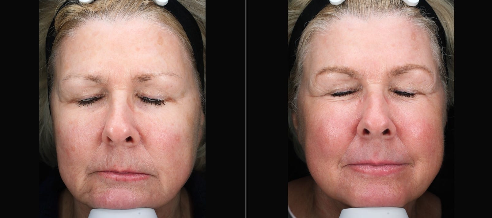 Patient 90 Marge Image