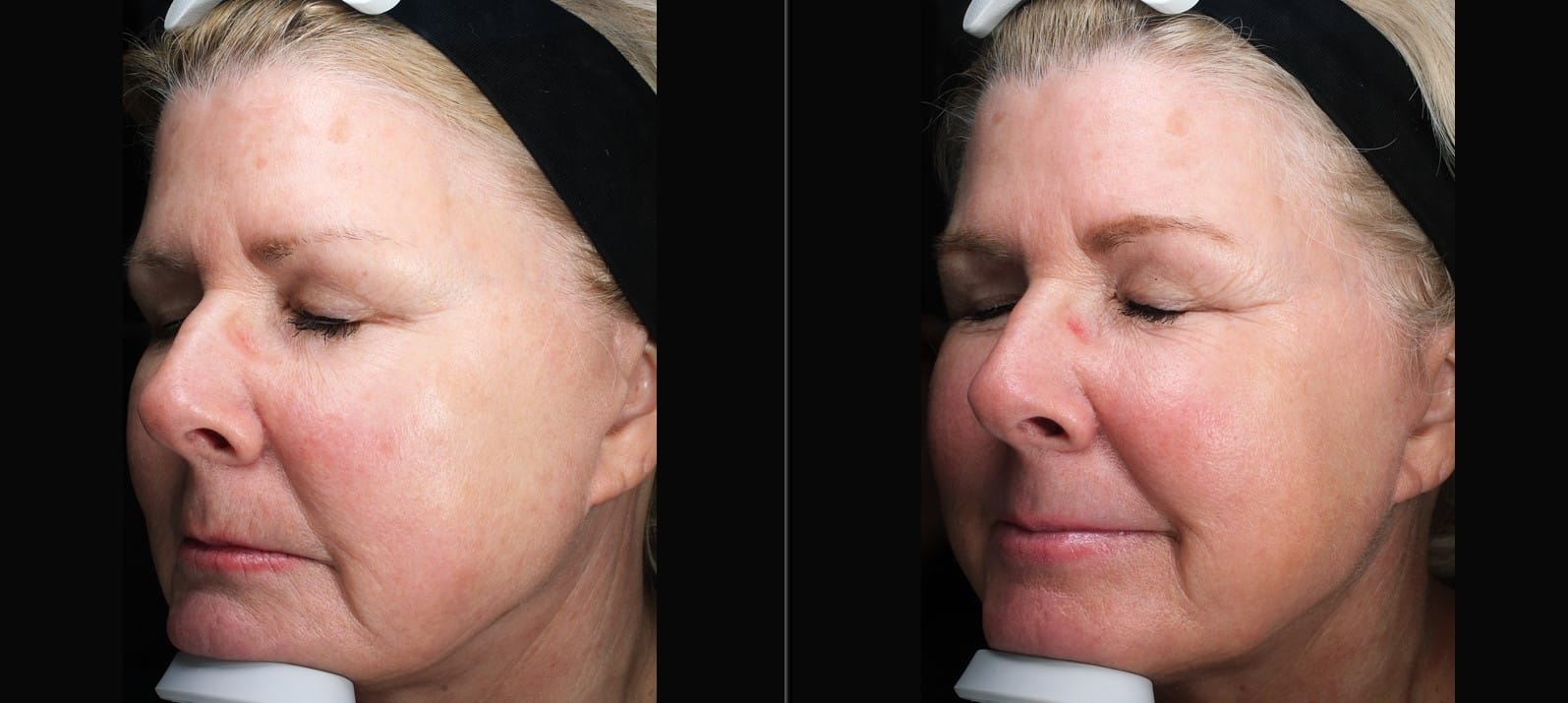 Patient 90 Marge Image