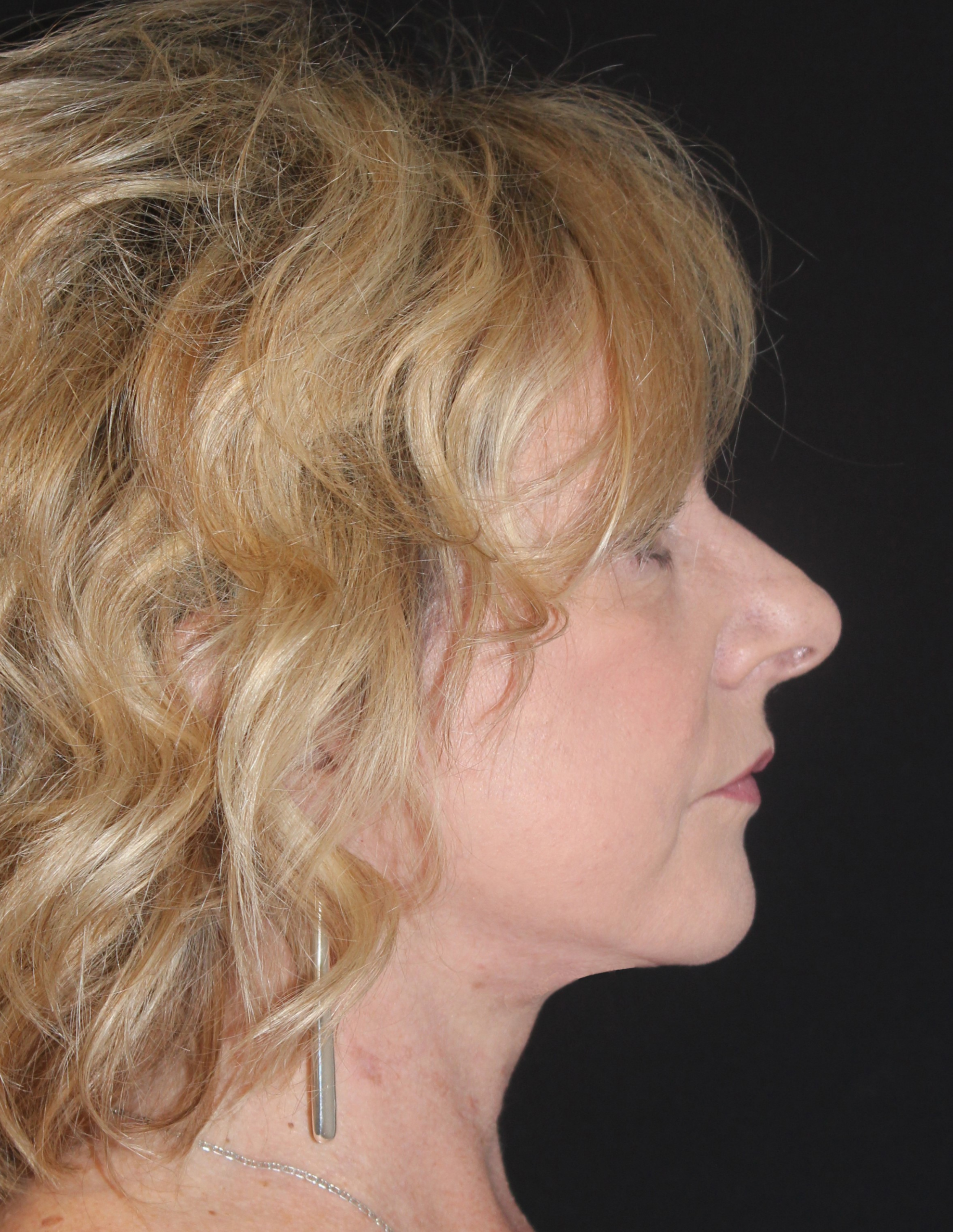 Patient 79 After Image