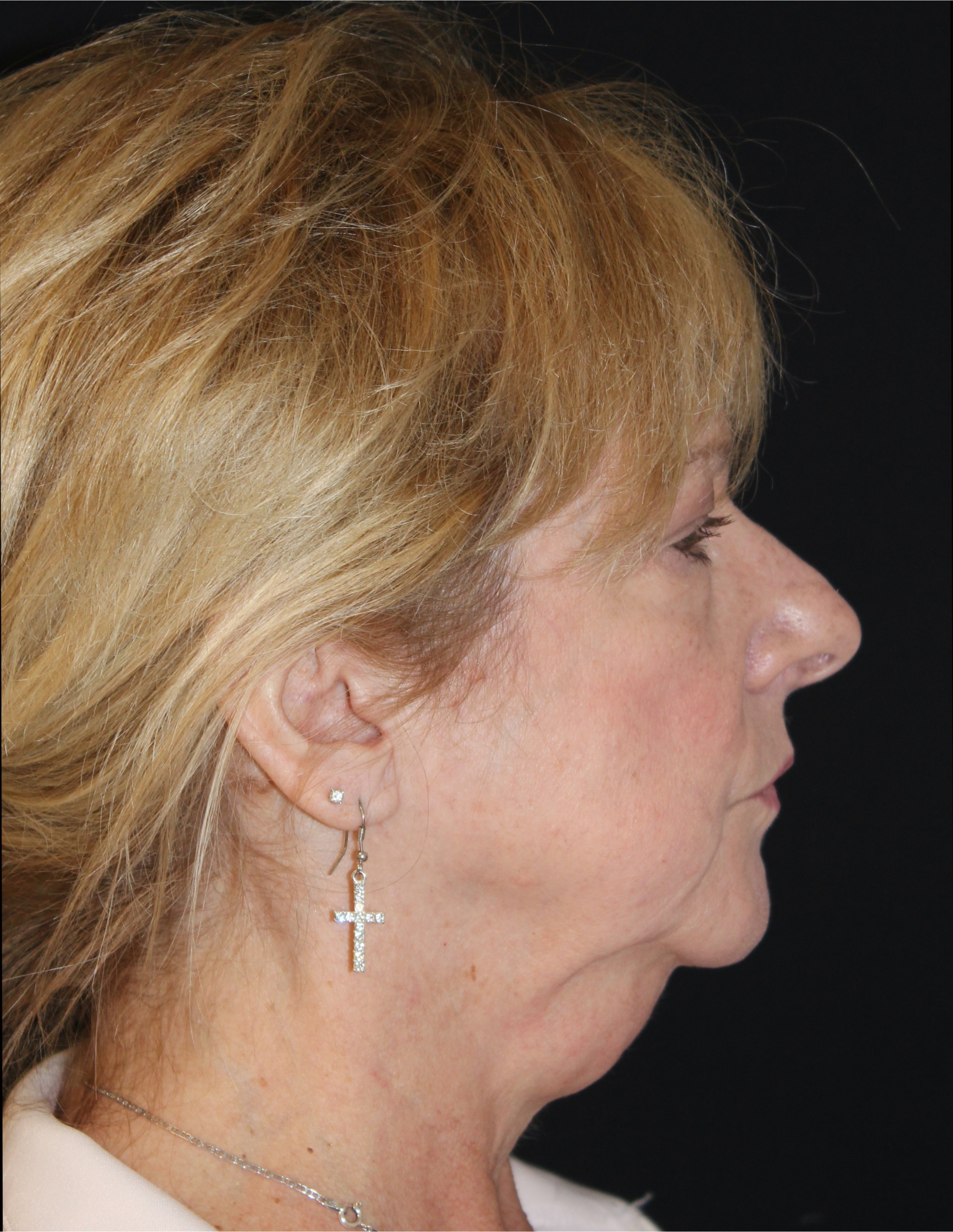 Patient 79 Before Image